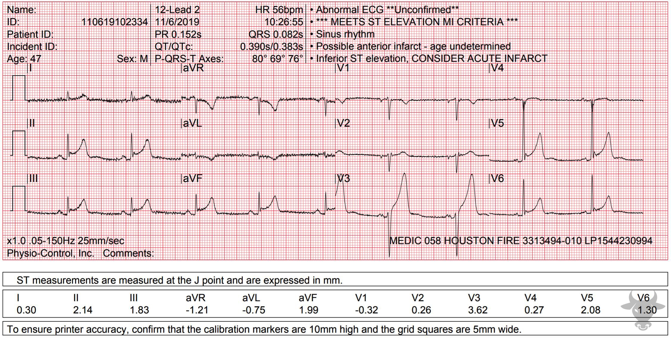 ECG Showing ST-elevation Myocardial Infarction