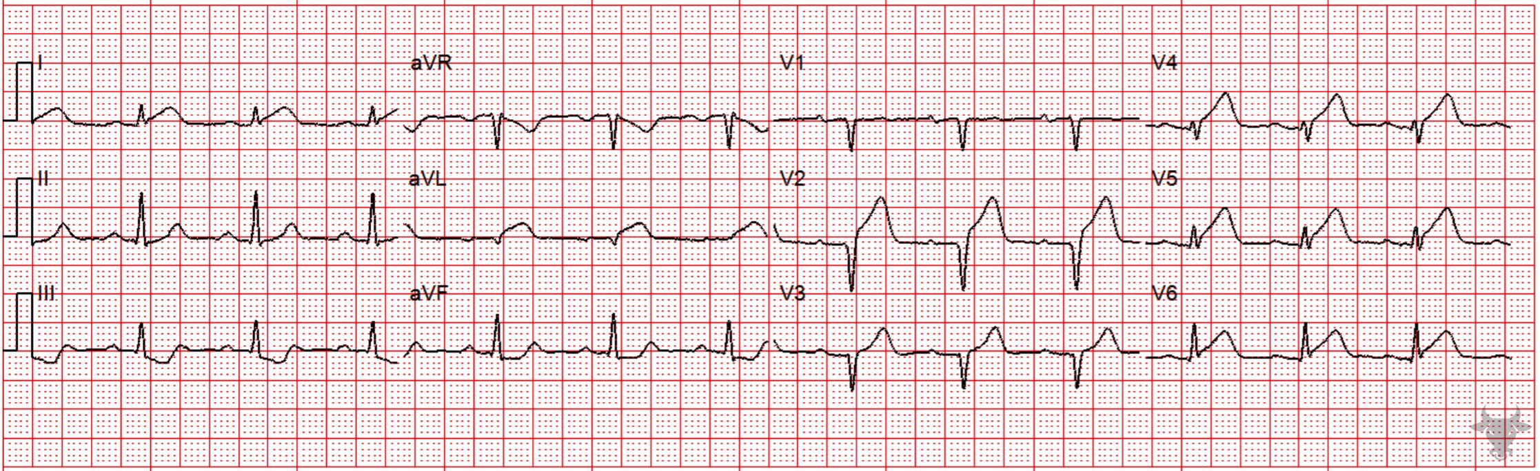 ECG Showing ST-elevation Myocardial Infarction