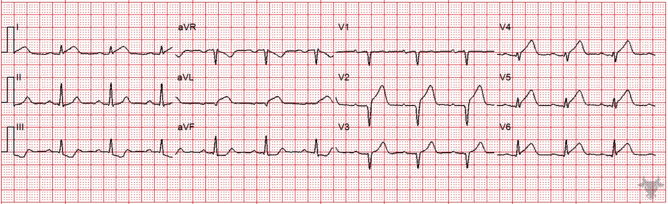 ECG Showing ST-elevation Myocardial Infarction