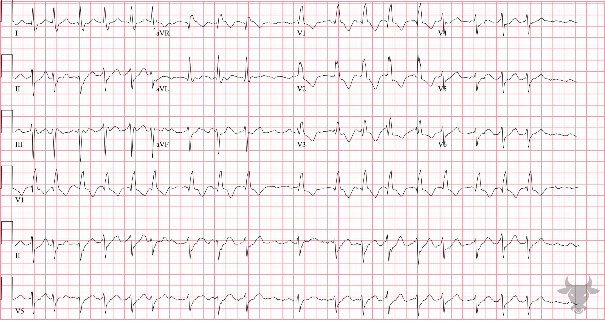 ECG Showing Right Bundle Branch Block