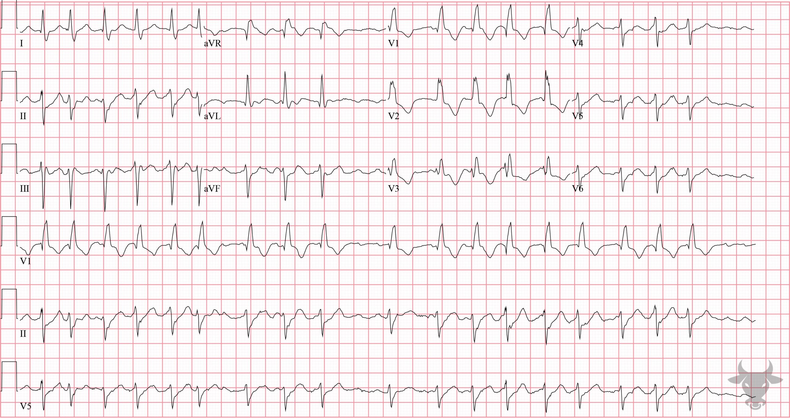 ECG Showing Right Bundle Branch Block