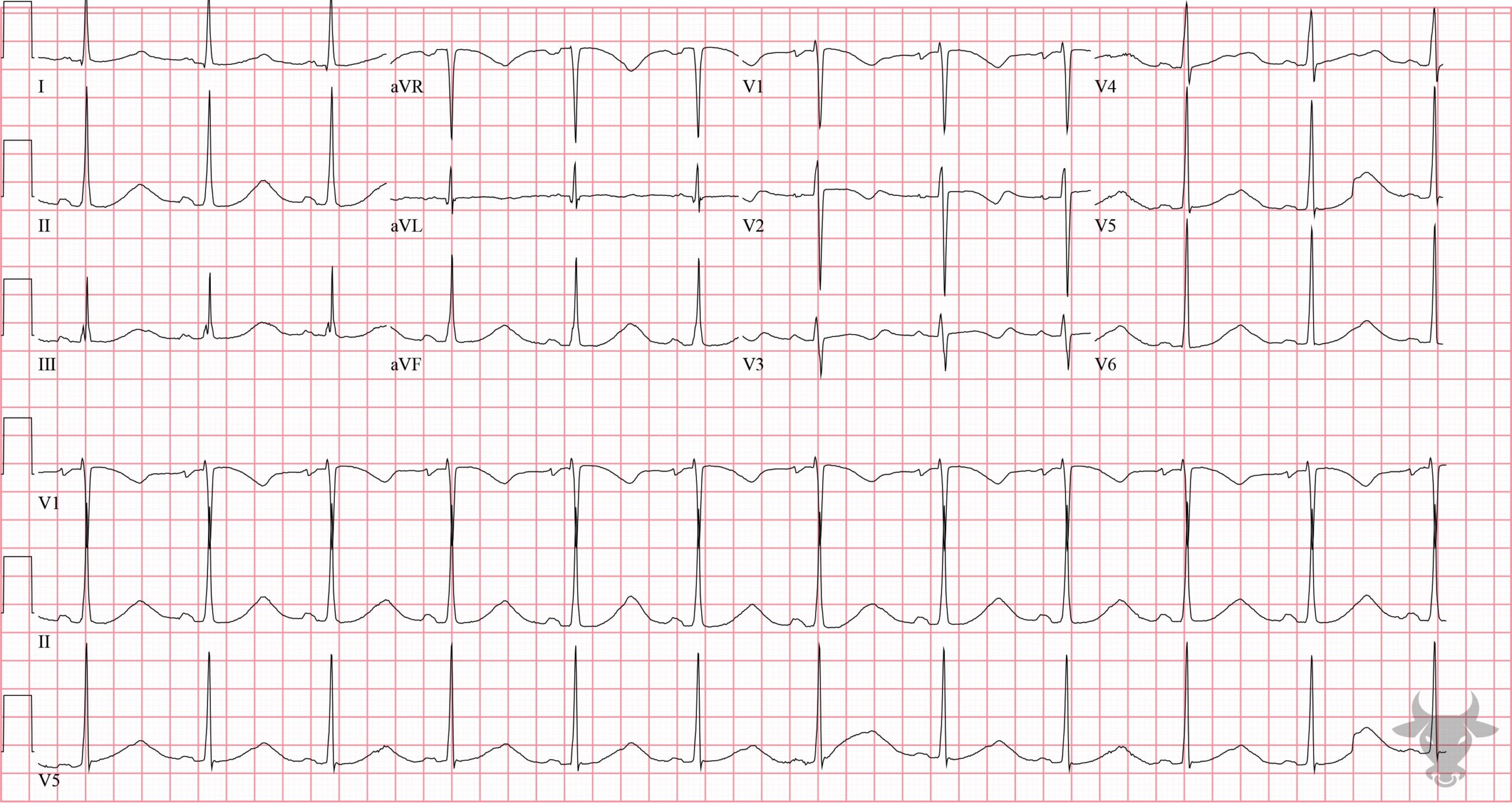 ECG Showing Prolonged QT