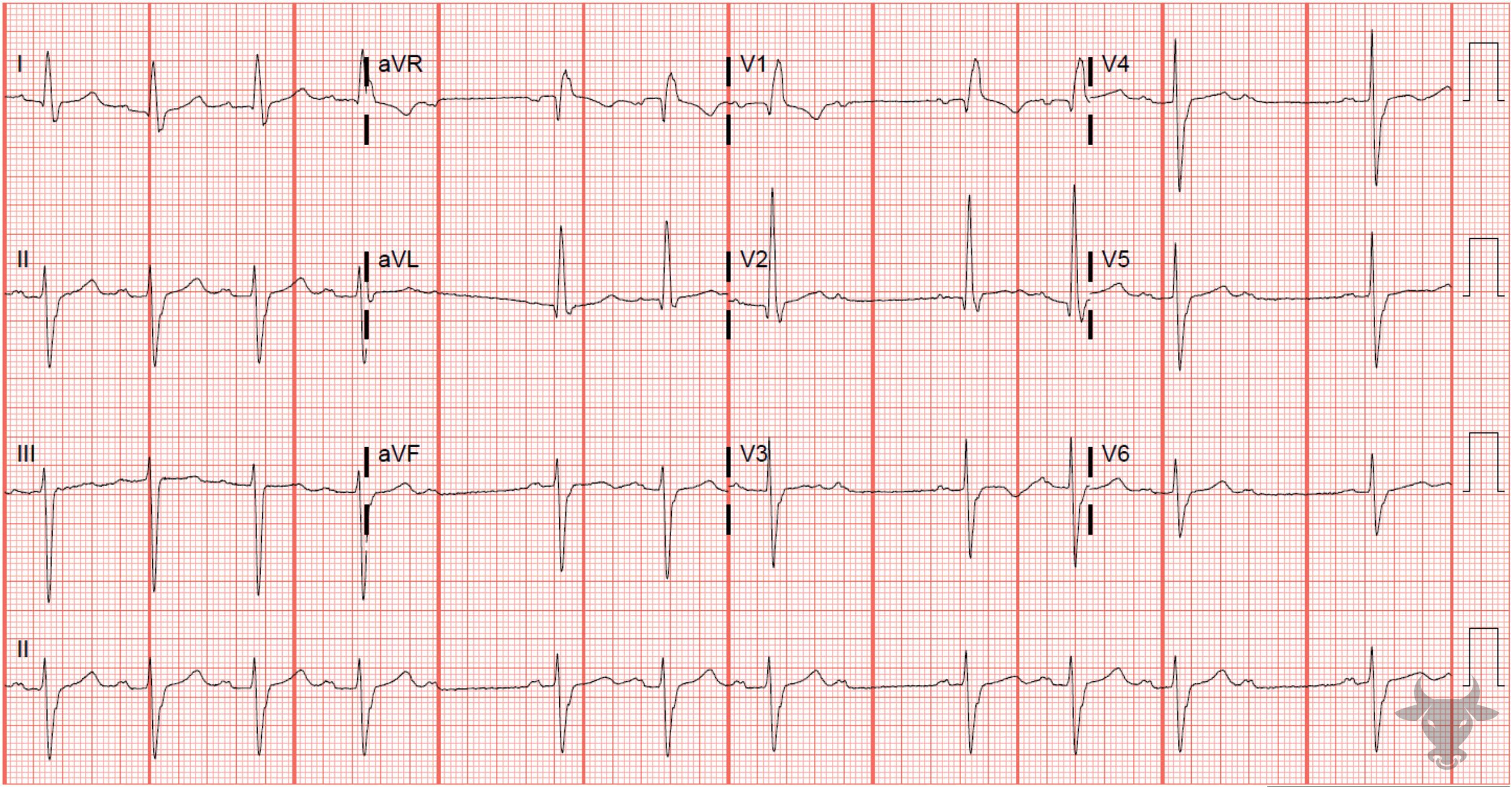 ECG Showing Second Degree Atrioventricular Block - Mobitz I