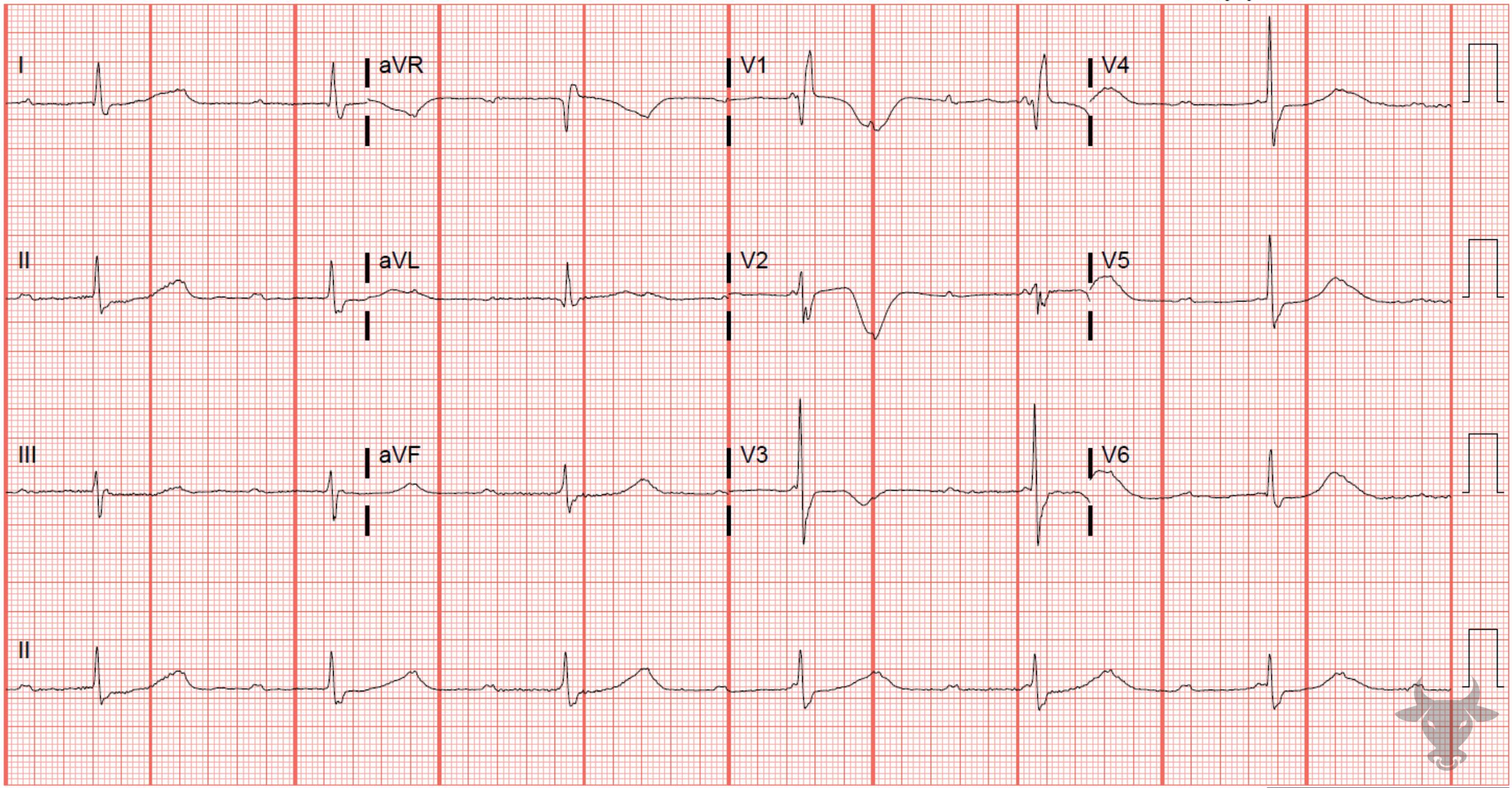 ECG Showing Third Degree Atrioventricular Block