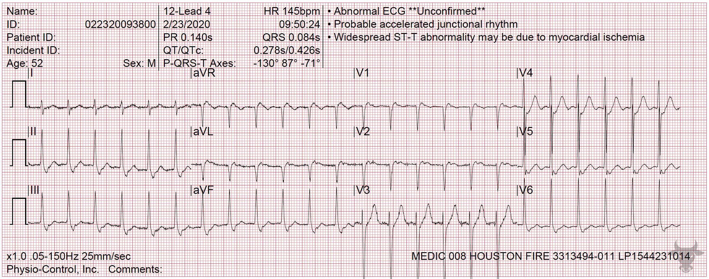 ECG Showing Atrioventricular Nodal Reentrant Tachycardia