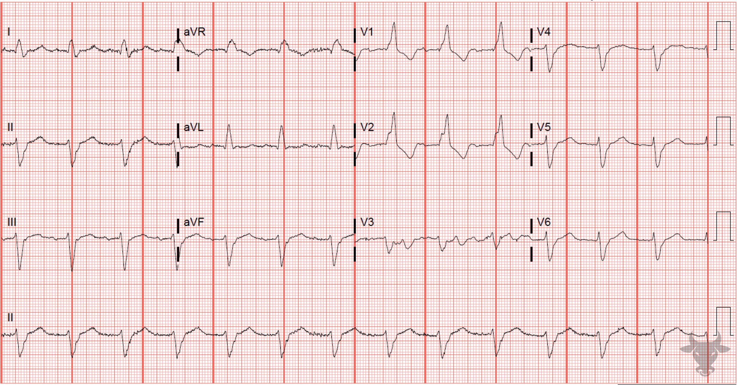 ECG Showing Trifascicular Block