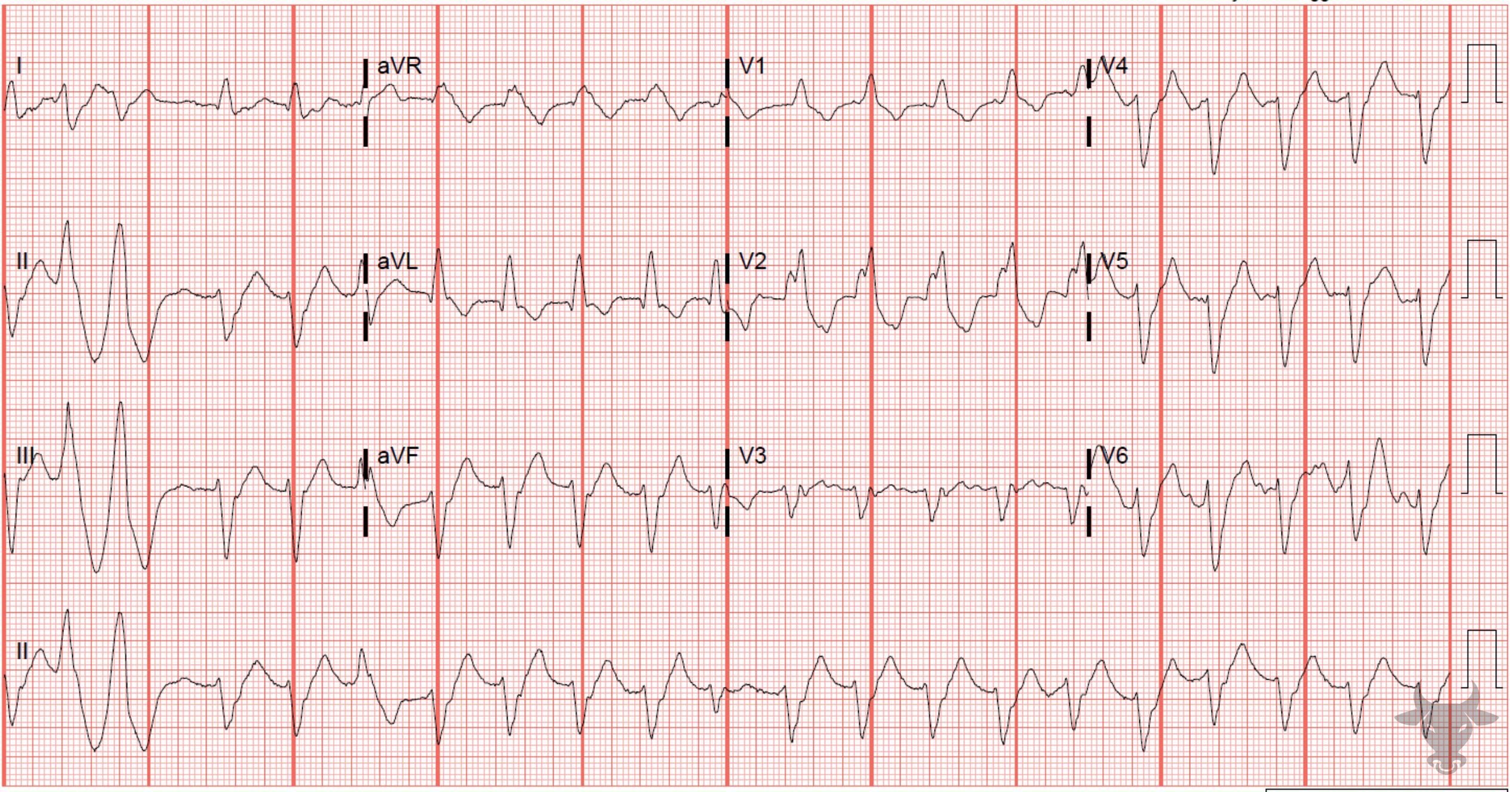 ECG Showing Trifascicular Block