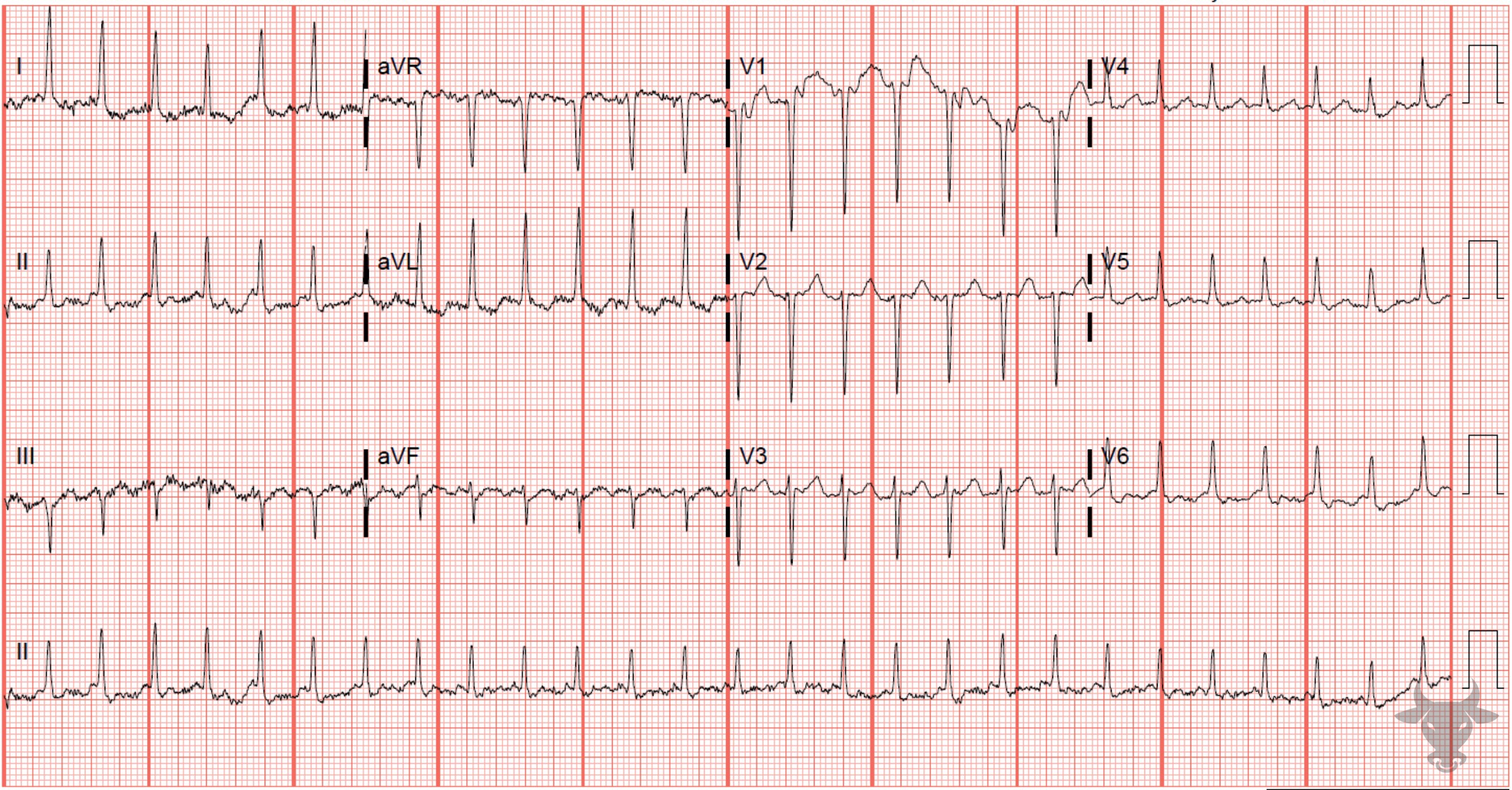 ECG Showing Atrial Flutter