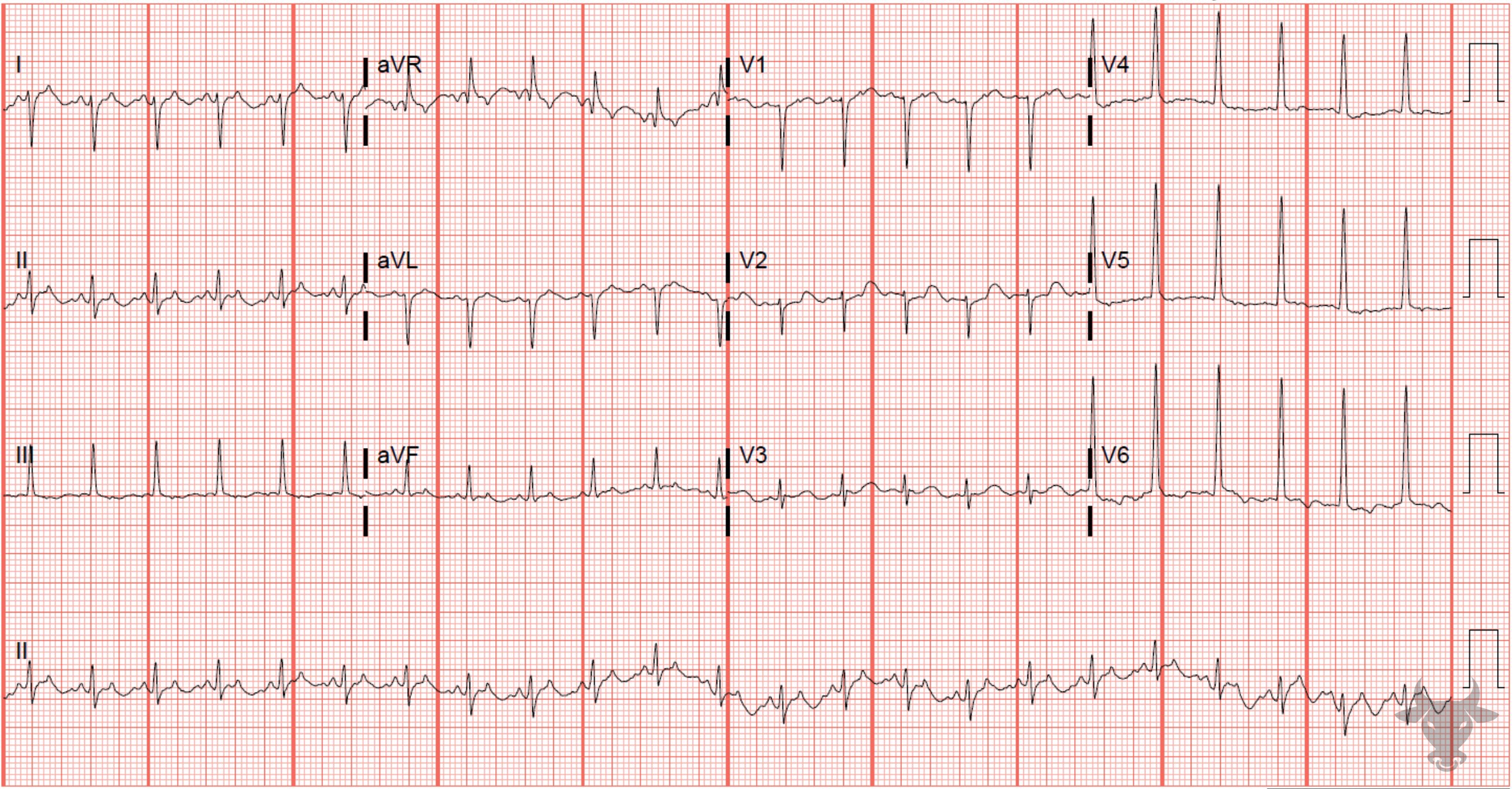 ECG Showing Lewis Lead