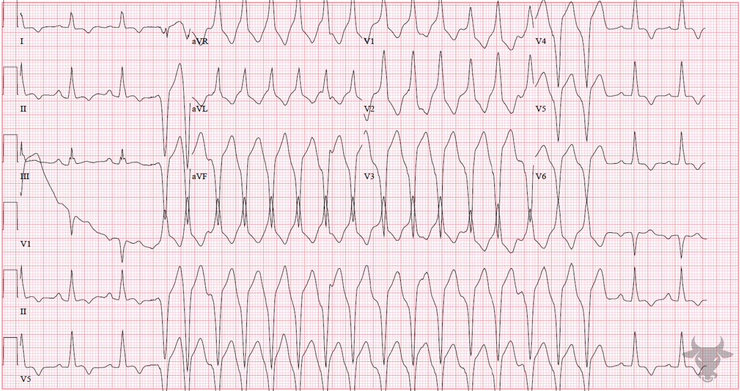 ECG Showing Hypertrophic Cardiomyopathy