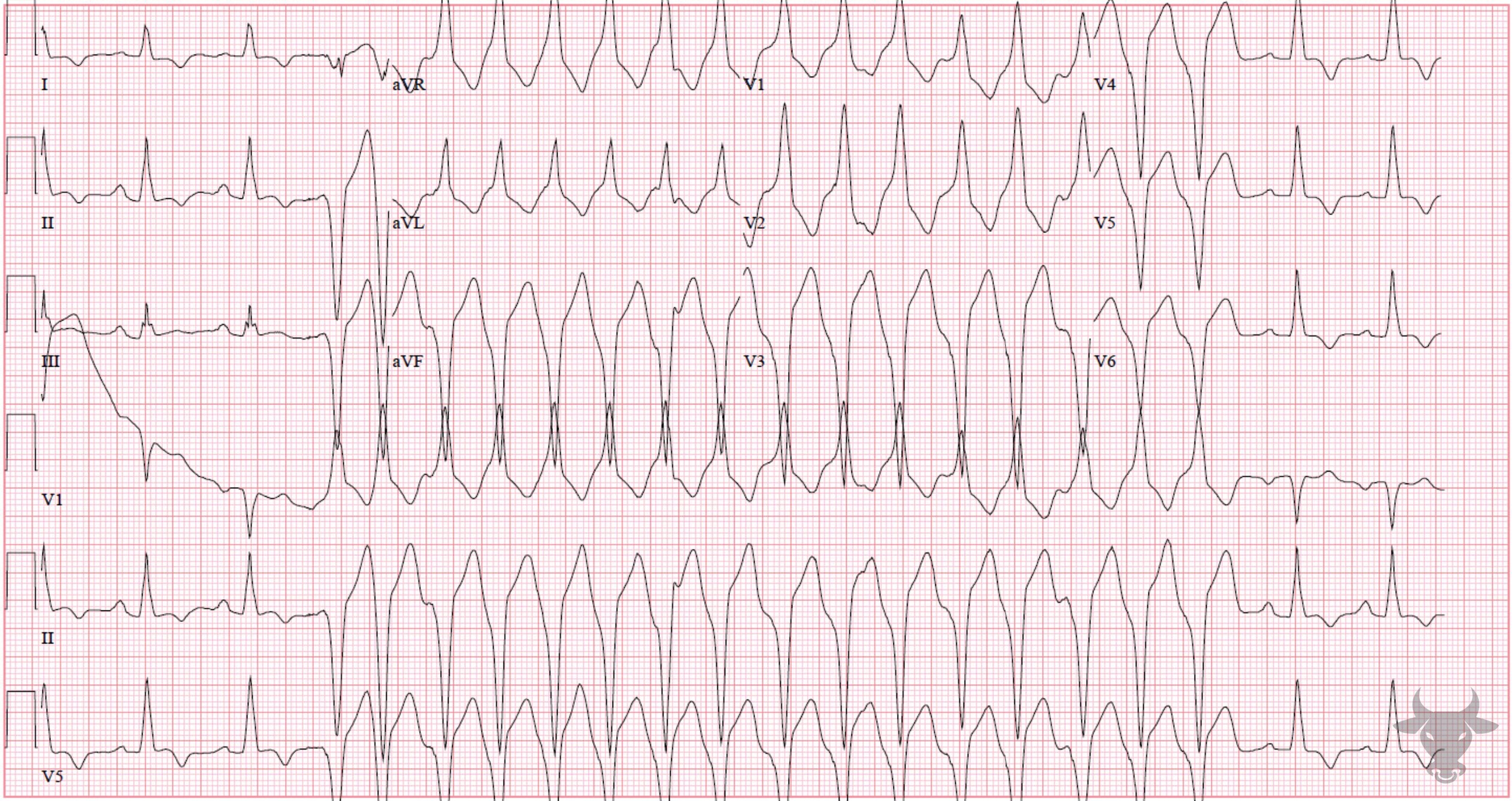 ECG Showing Ventricular Tachycardia