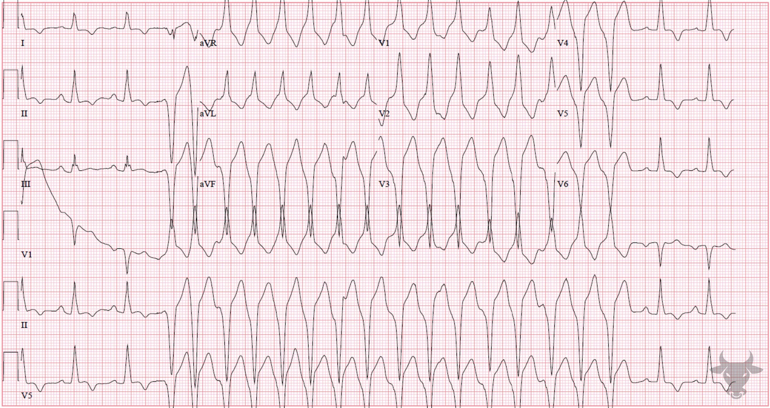 ECG Showing Ventricular Tachycardia