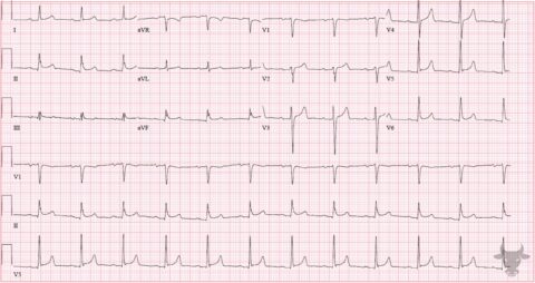 Acute Pericarditis | ECG Stampede