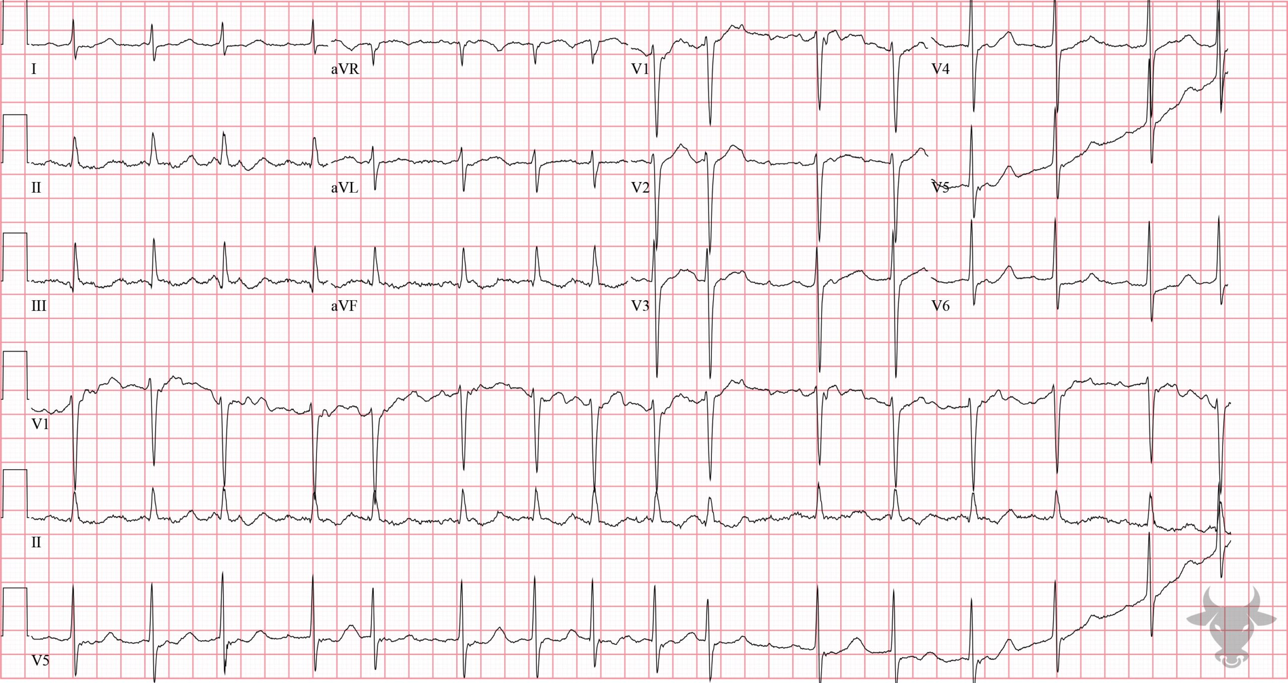 ECG Showing Sinus Node Dysfunction