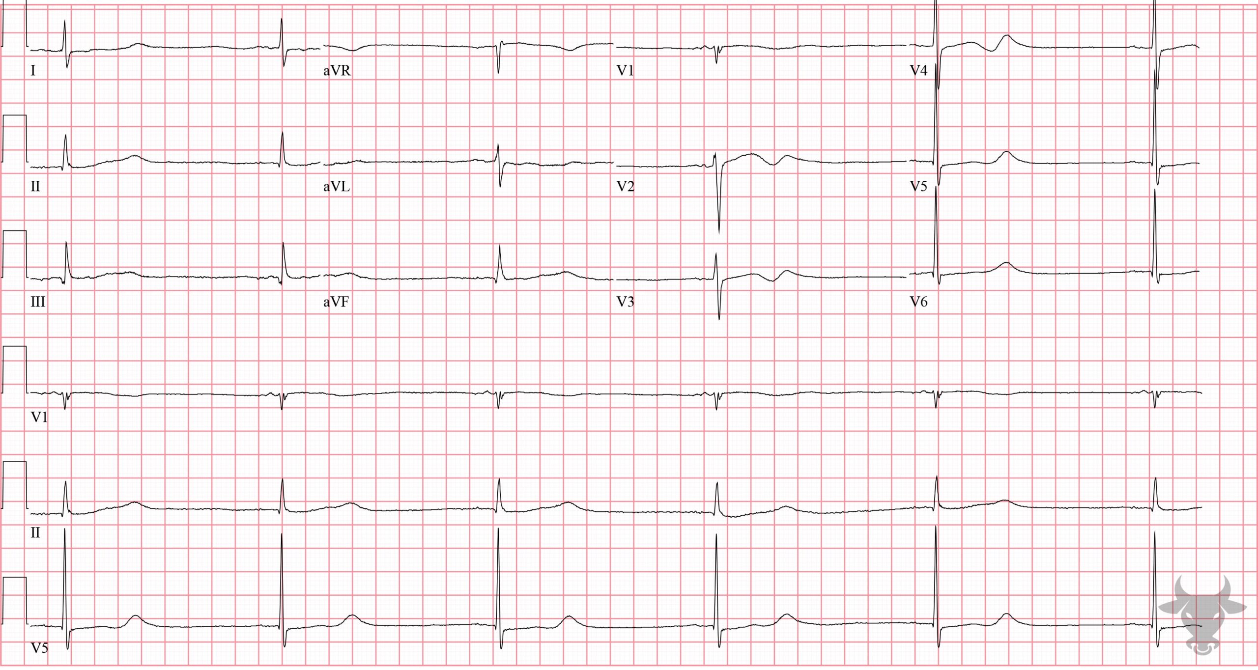 ECG Showing Sinus Node Dysfunction