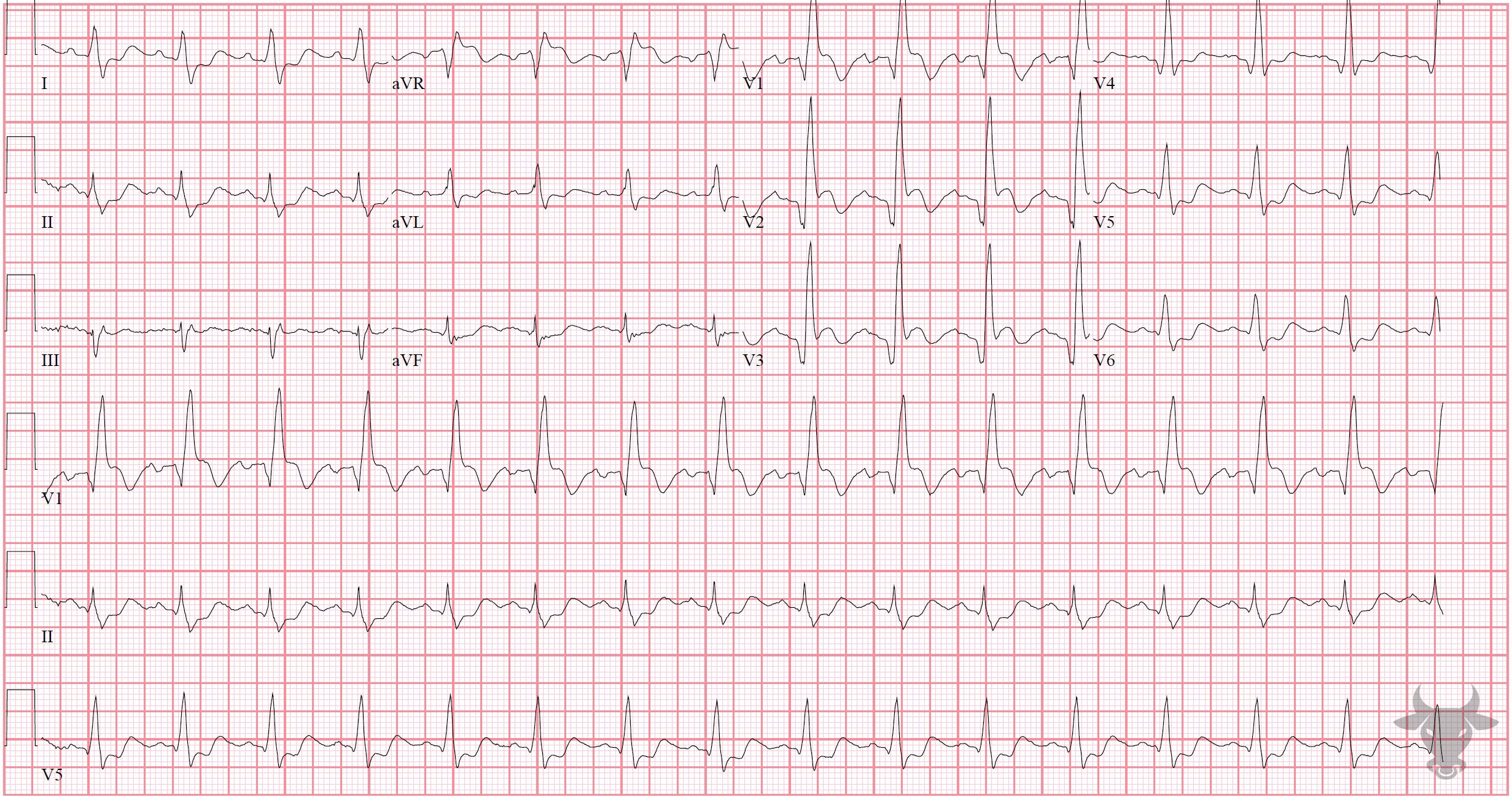 ECG Showing ST-elevation Myocardial Infarction