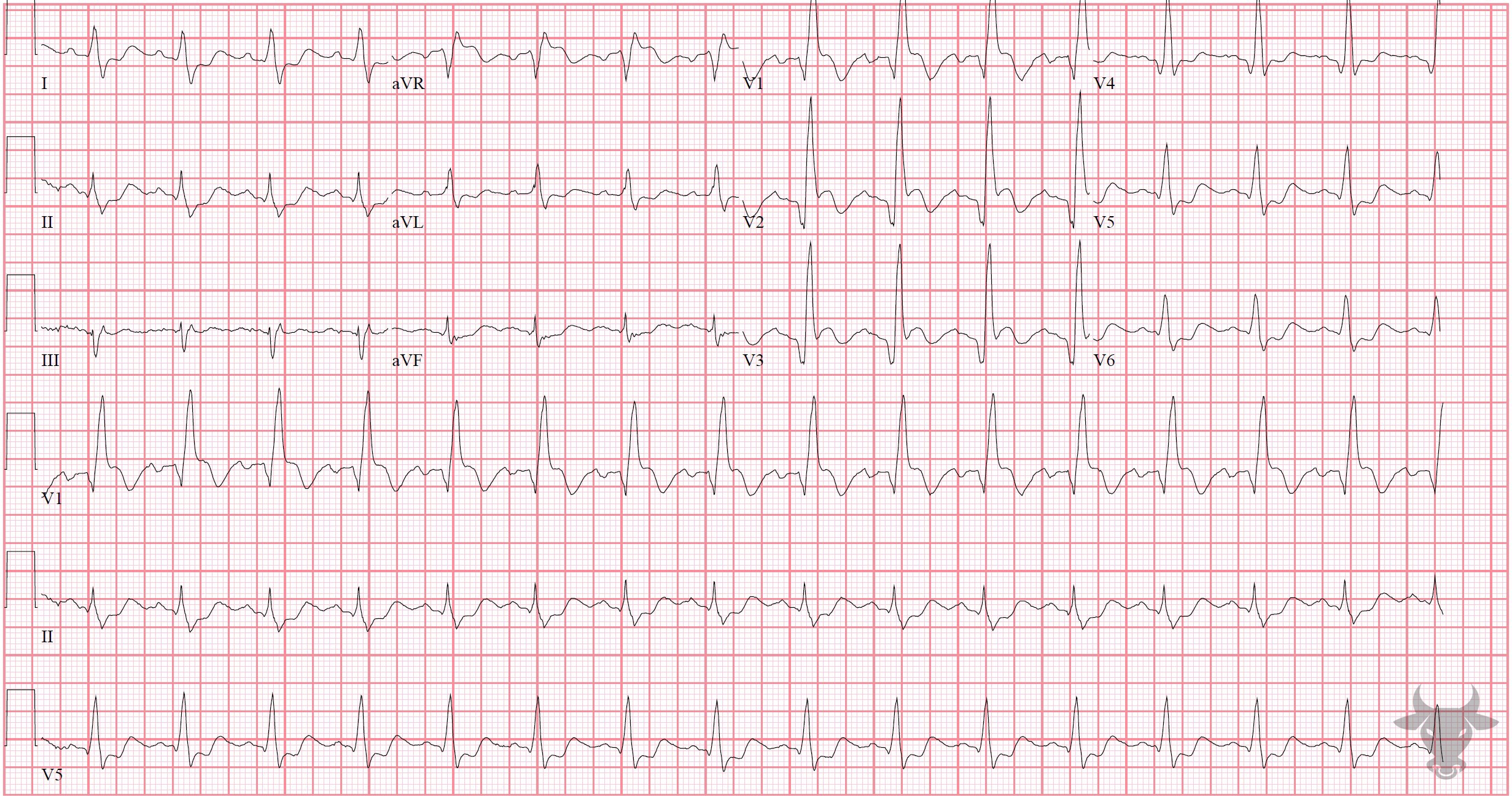 ECG Showing ST-elevation Myocardial Infarction