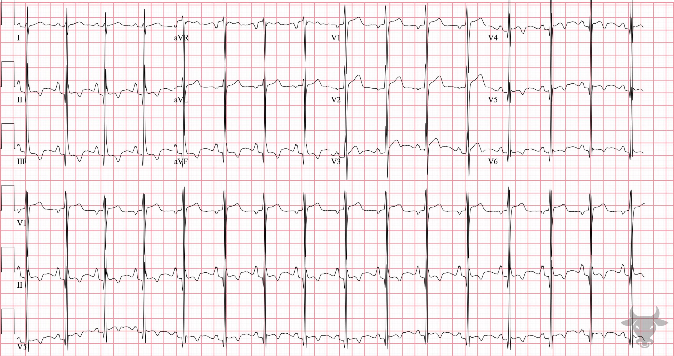 ECG Showing Right Atrial Enlargement