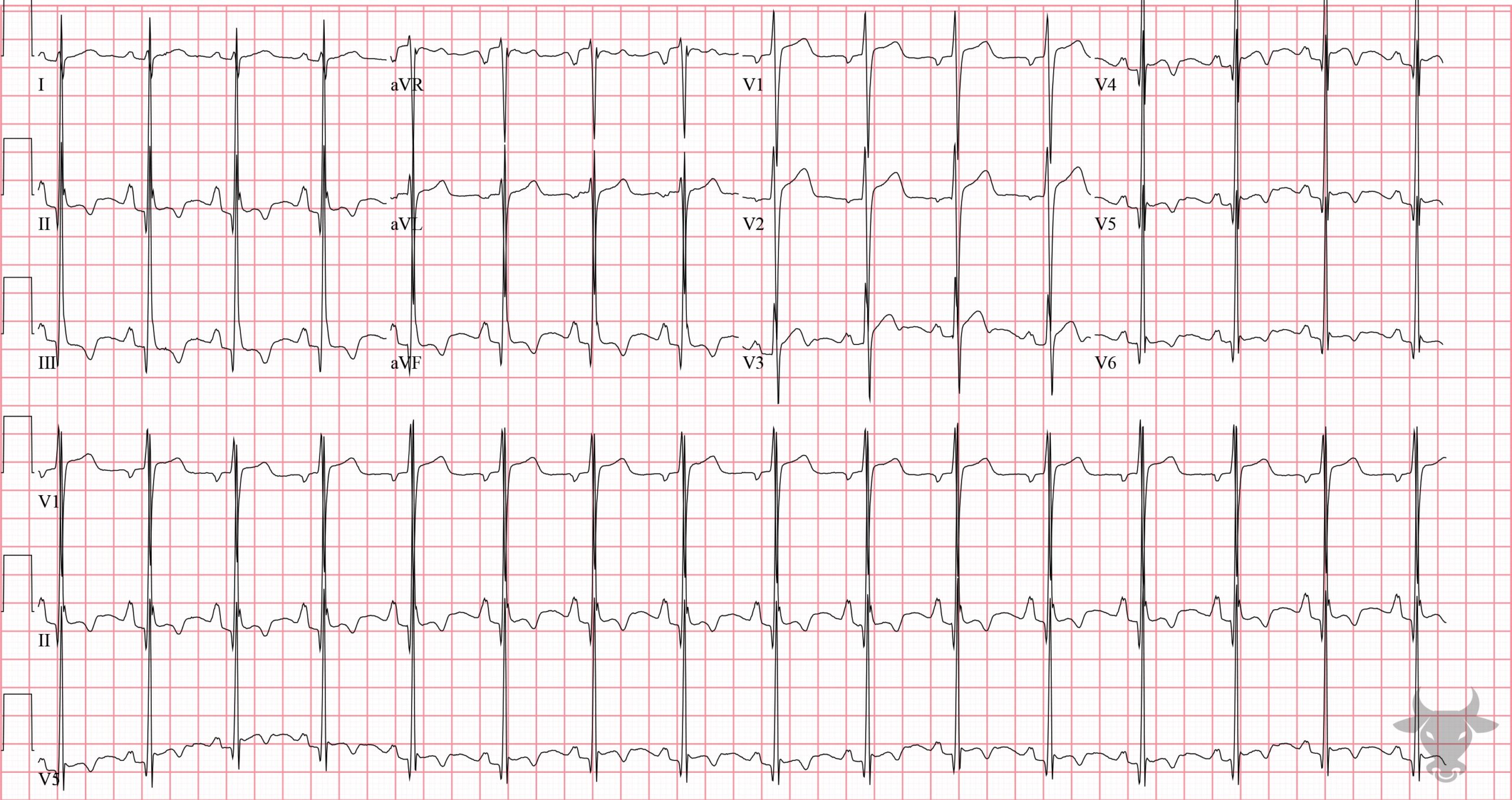 ECG Showing Right Atrial Enlargement