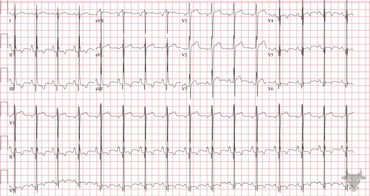 T-wave Inversions | ECG Stampede