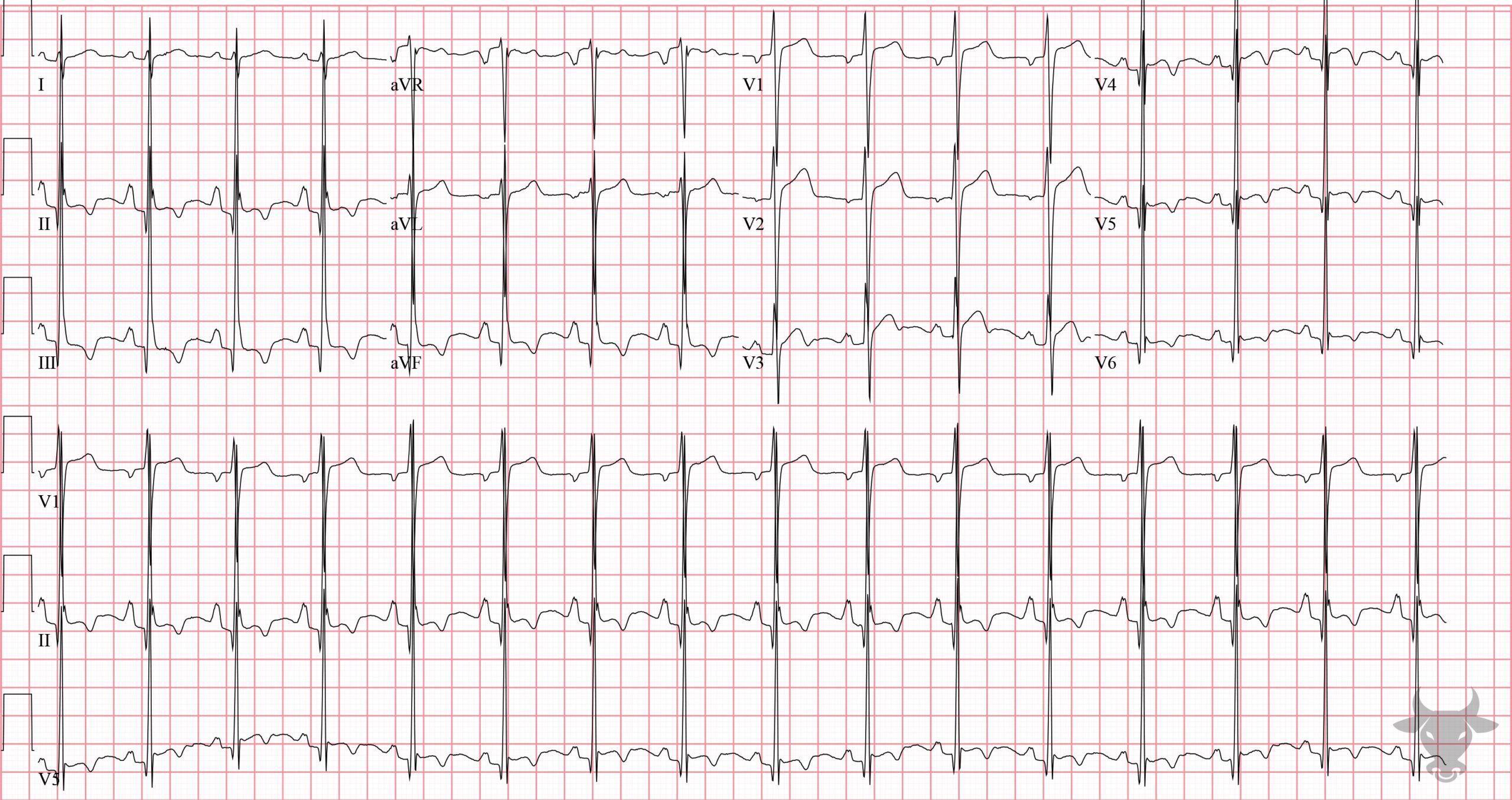 ECG Showing Left Ventricular Hypertrophy