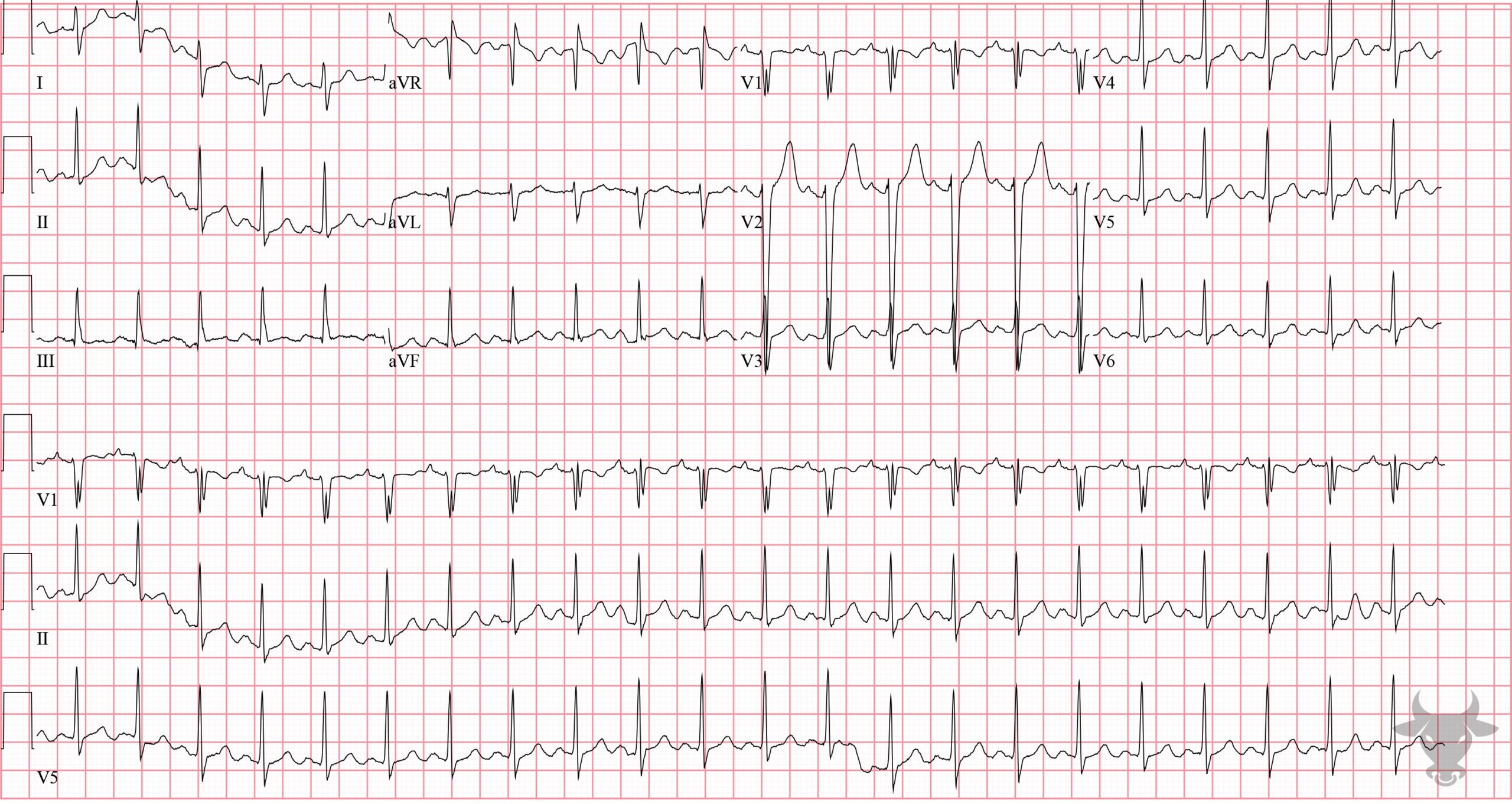 ECG Showing Sodium Channel Toxicity