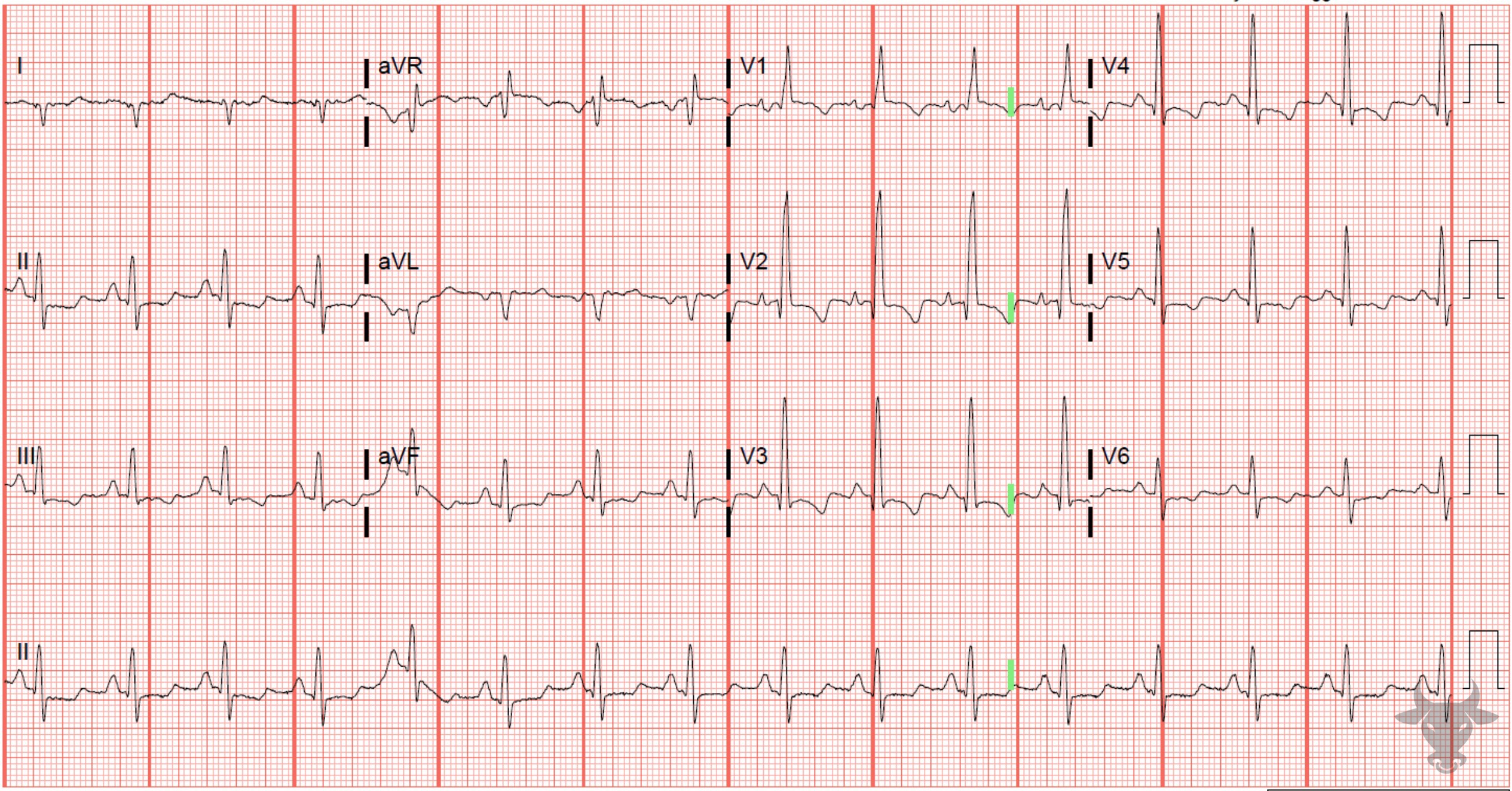 ECG Showing Right Heart Strain