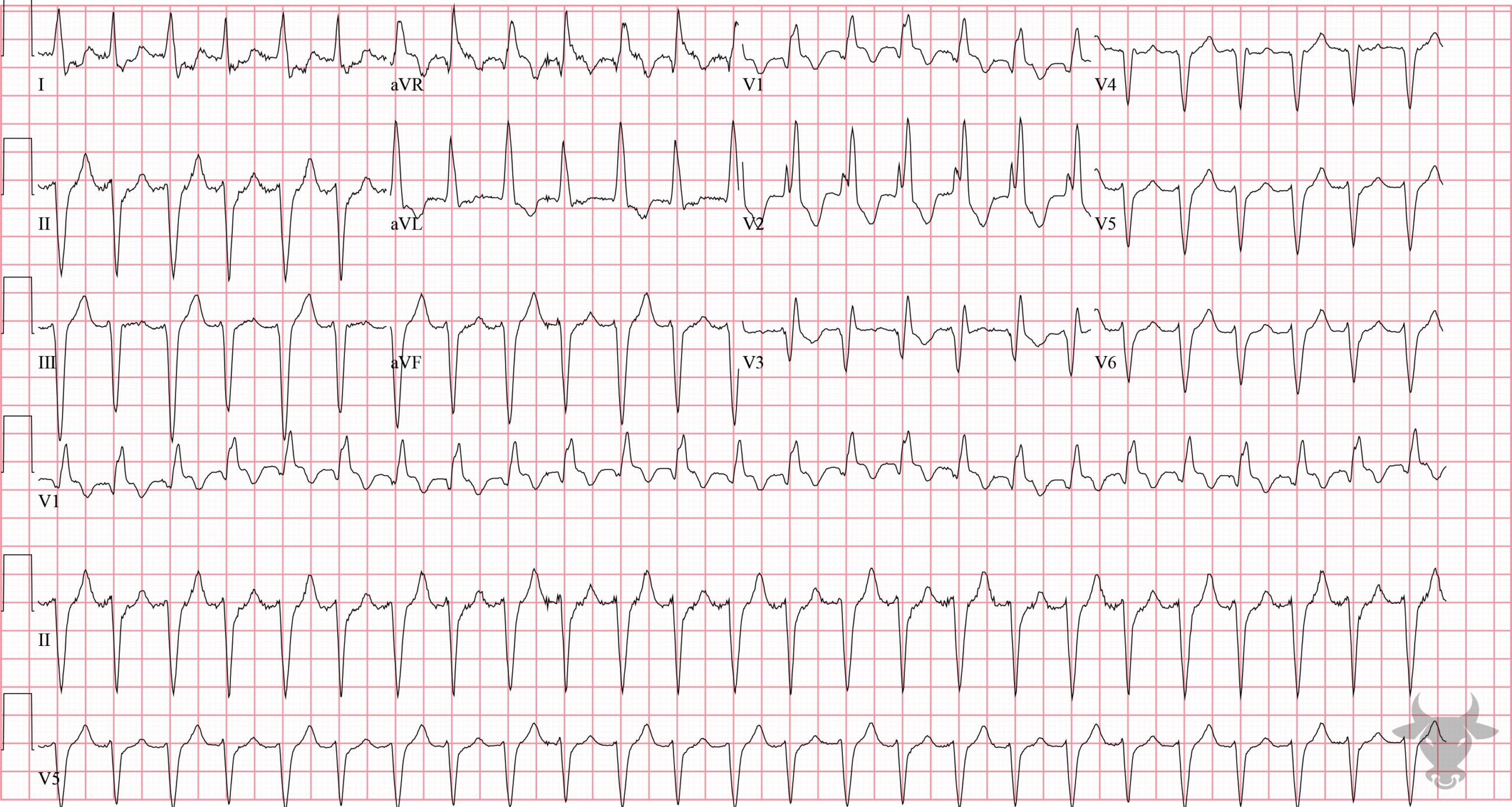 ECG Showing Supraventricular Tachycardia with Aberrancy