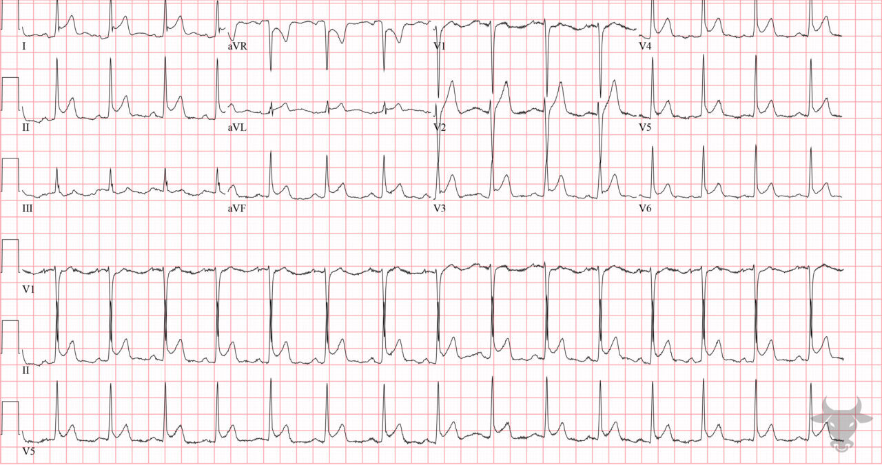 Acute Pericarditis | ECG Stampede