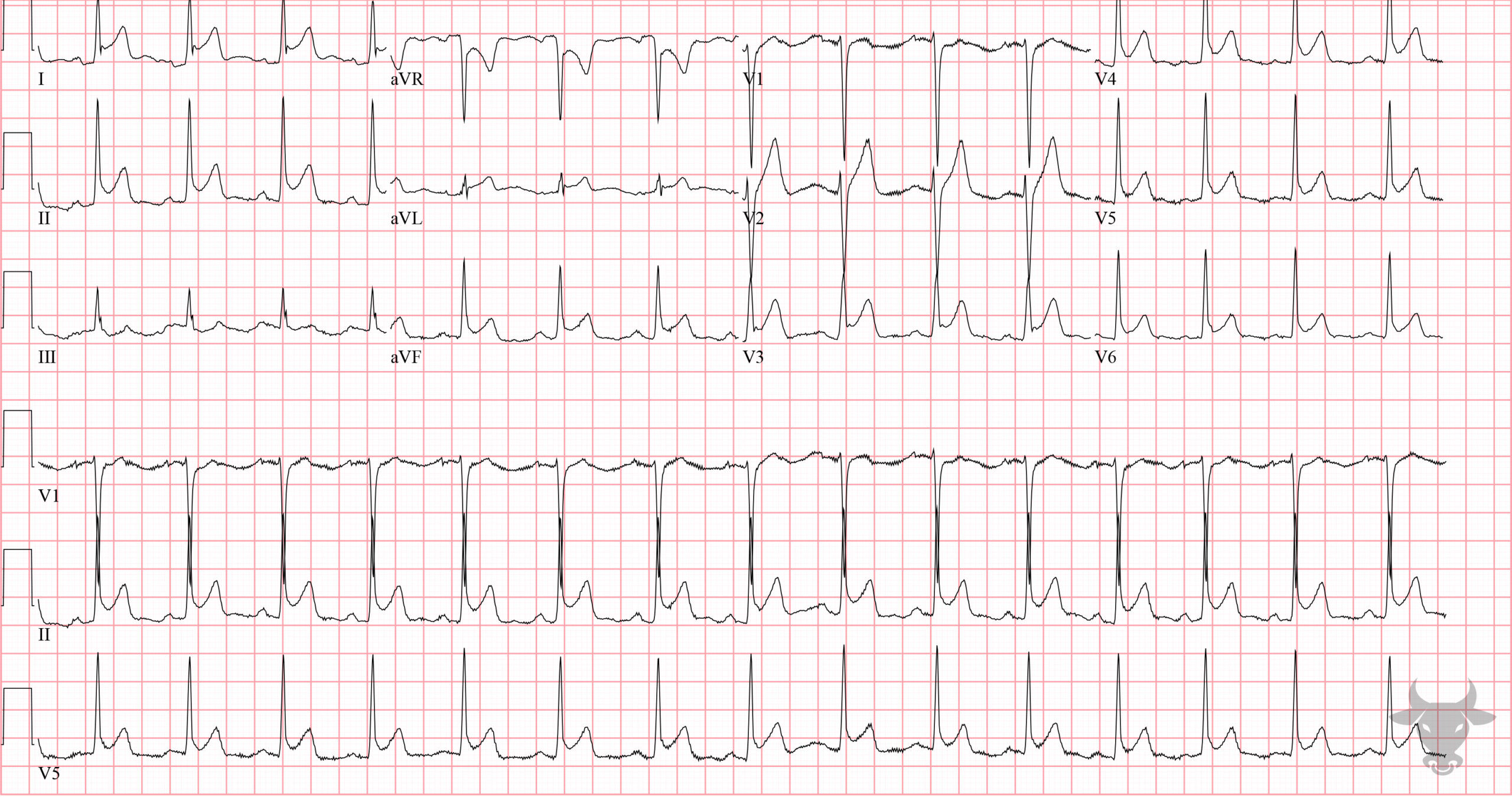 ECG Showing Acute Pericarditis