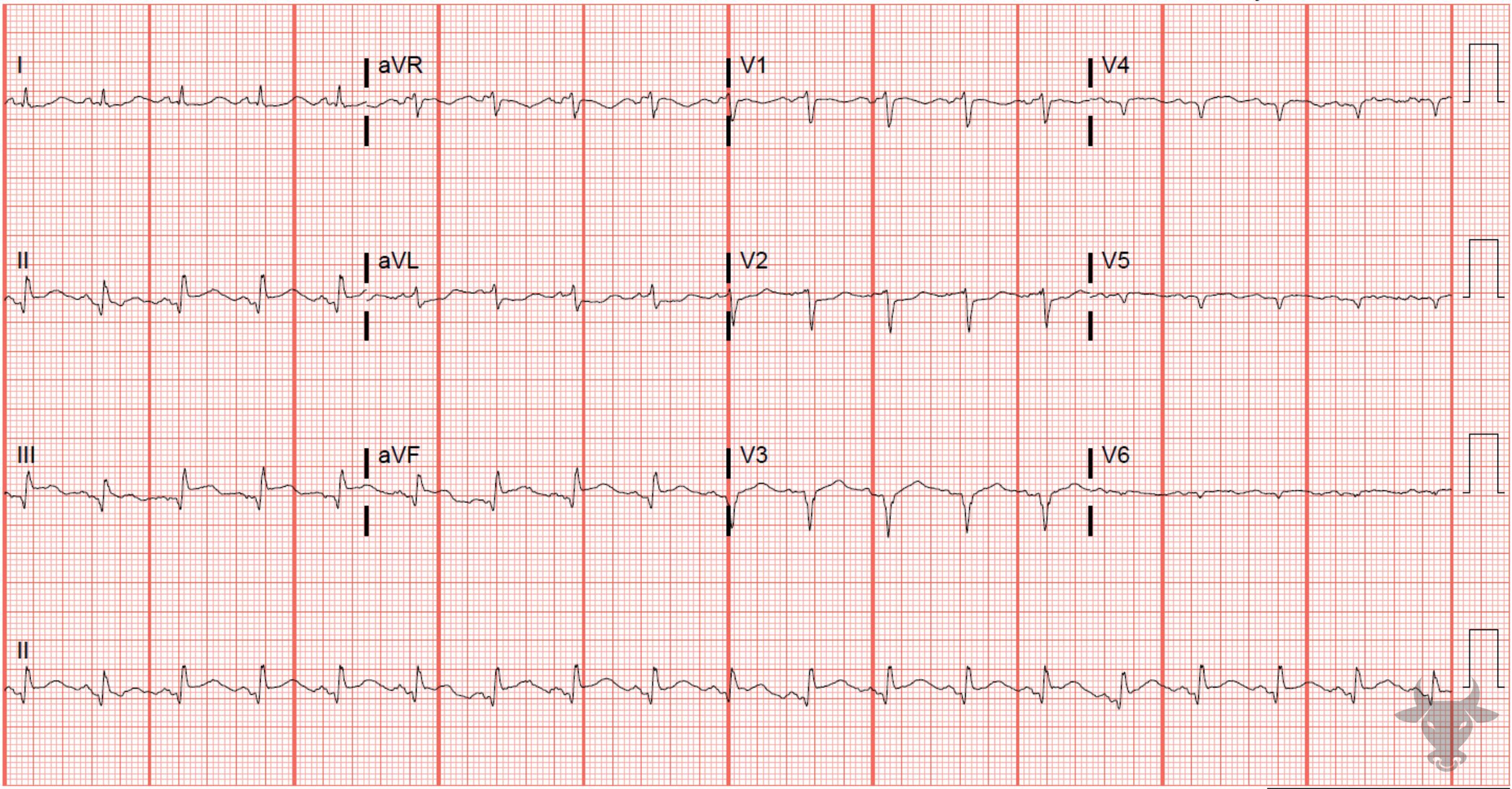 ECG Showing ST-elevation Myocardial Infarction