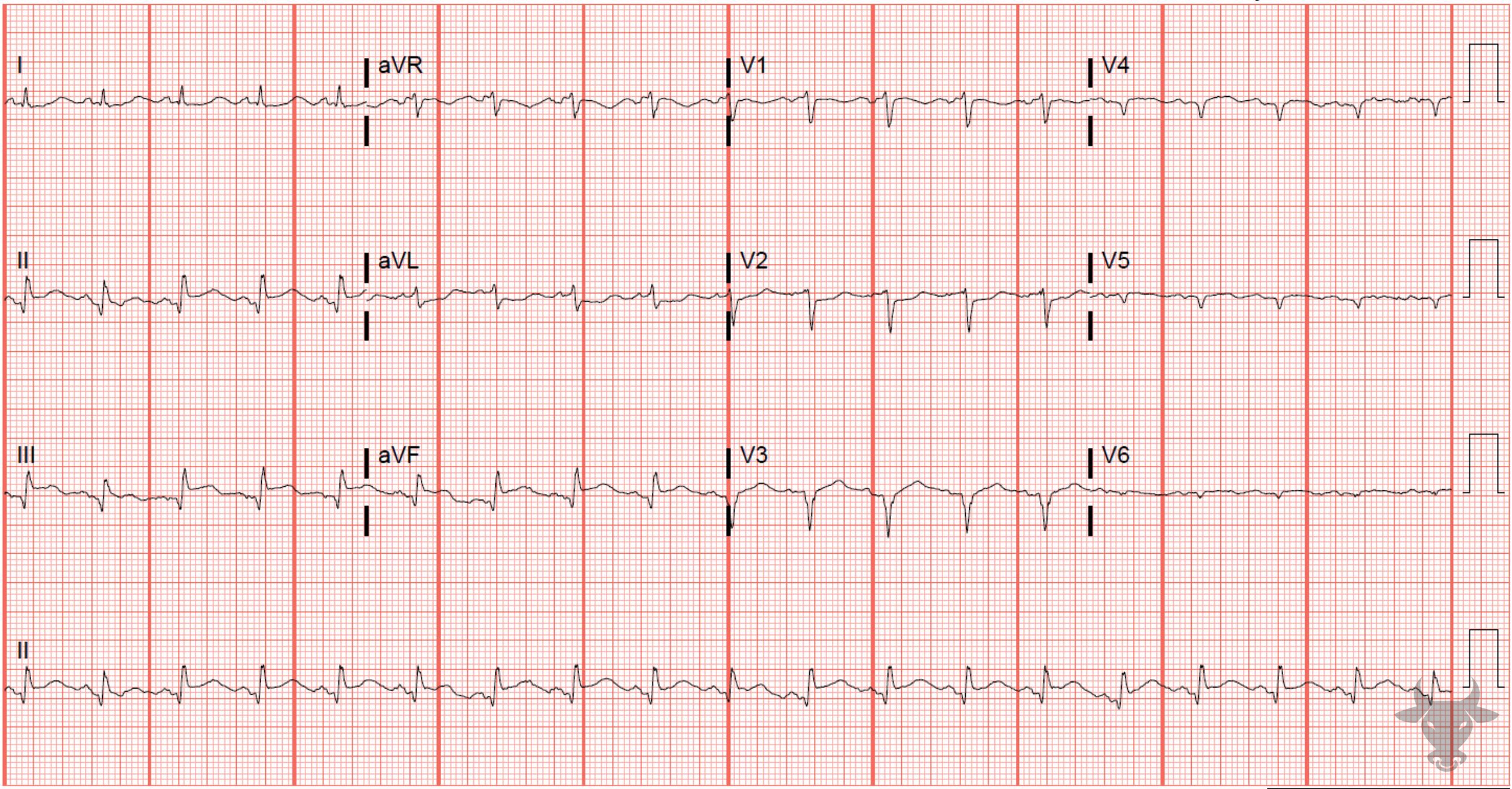 ECG Showing ST-elevation Myocardial Infarction