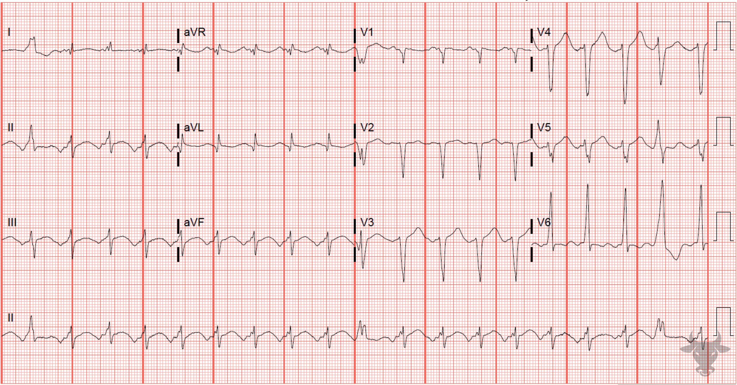 ECG Showing Atrial Tachycardia