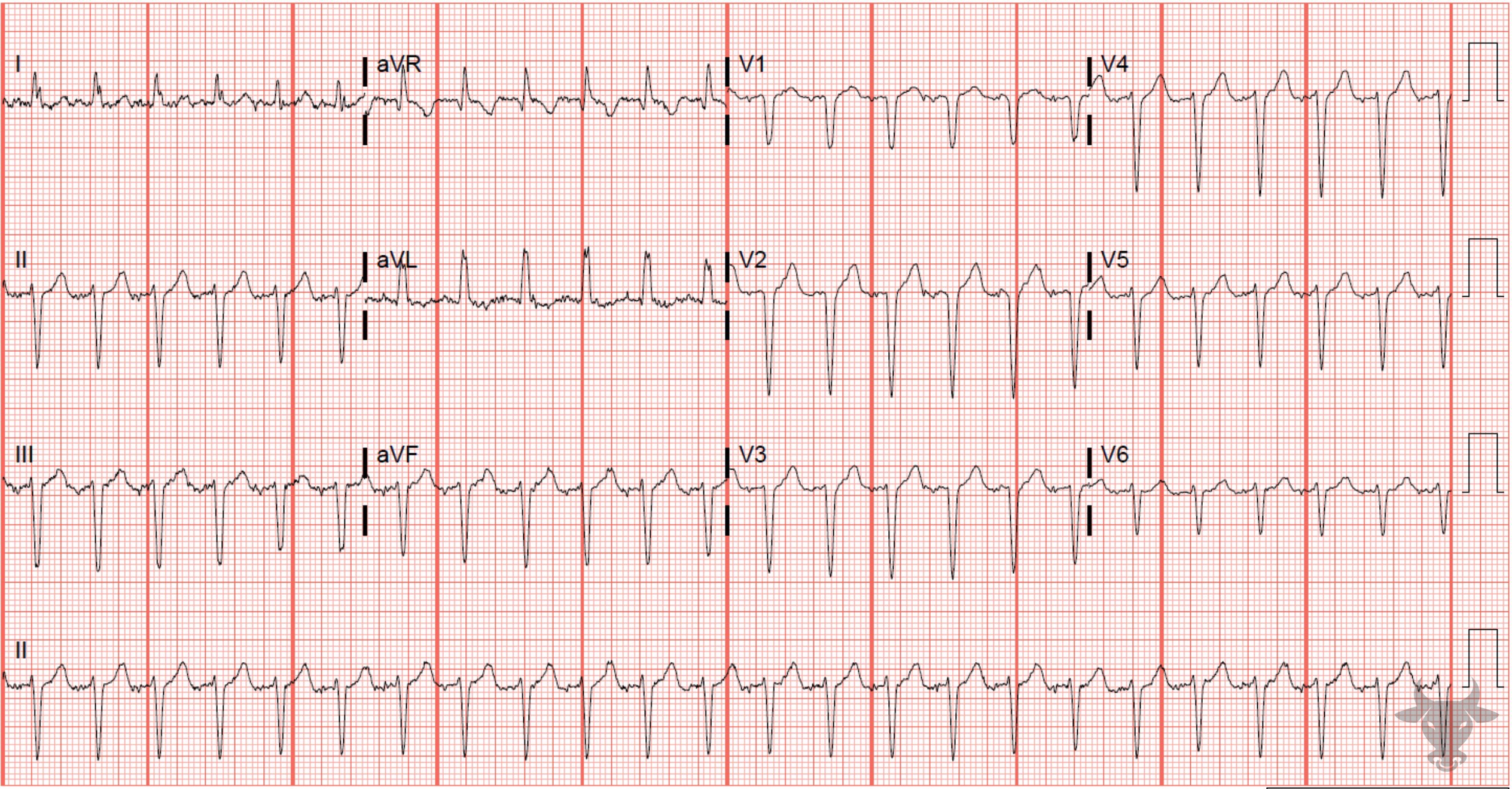 ECG Showing Supraventricular Tachycardia