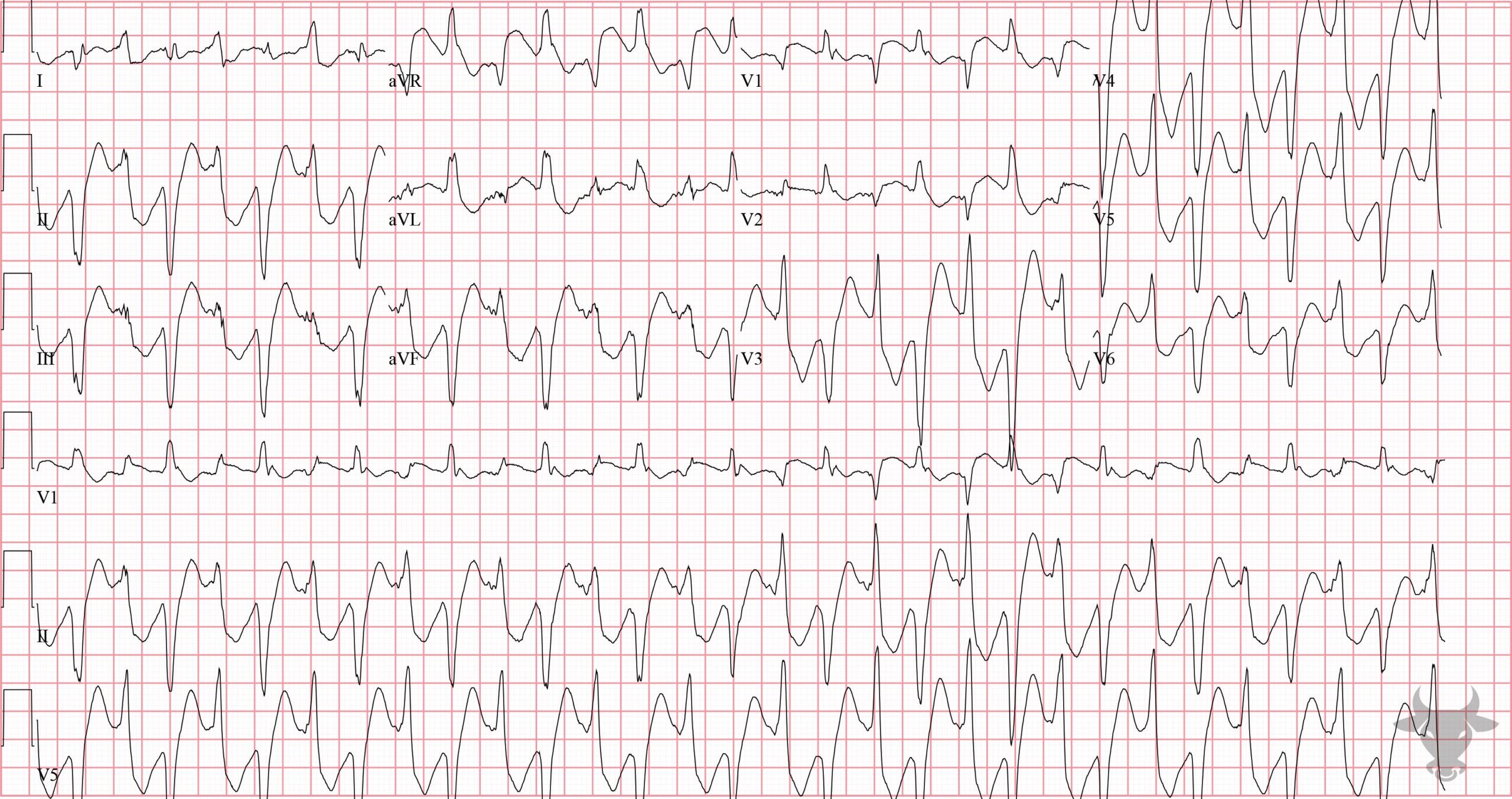 ECG Showing Polymorphic Ventricular Tachycardia