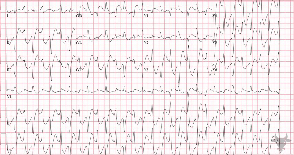 Polymorphic ventricular tachycardia ecg stampede