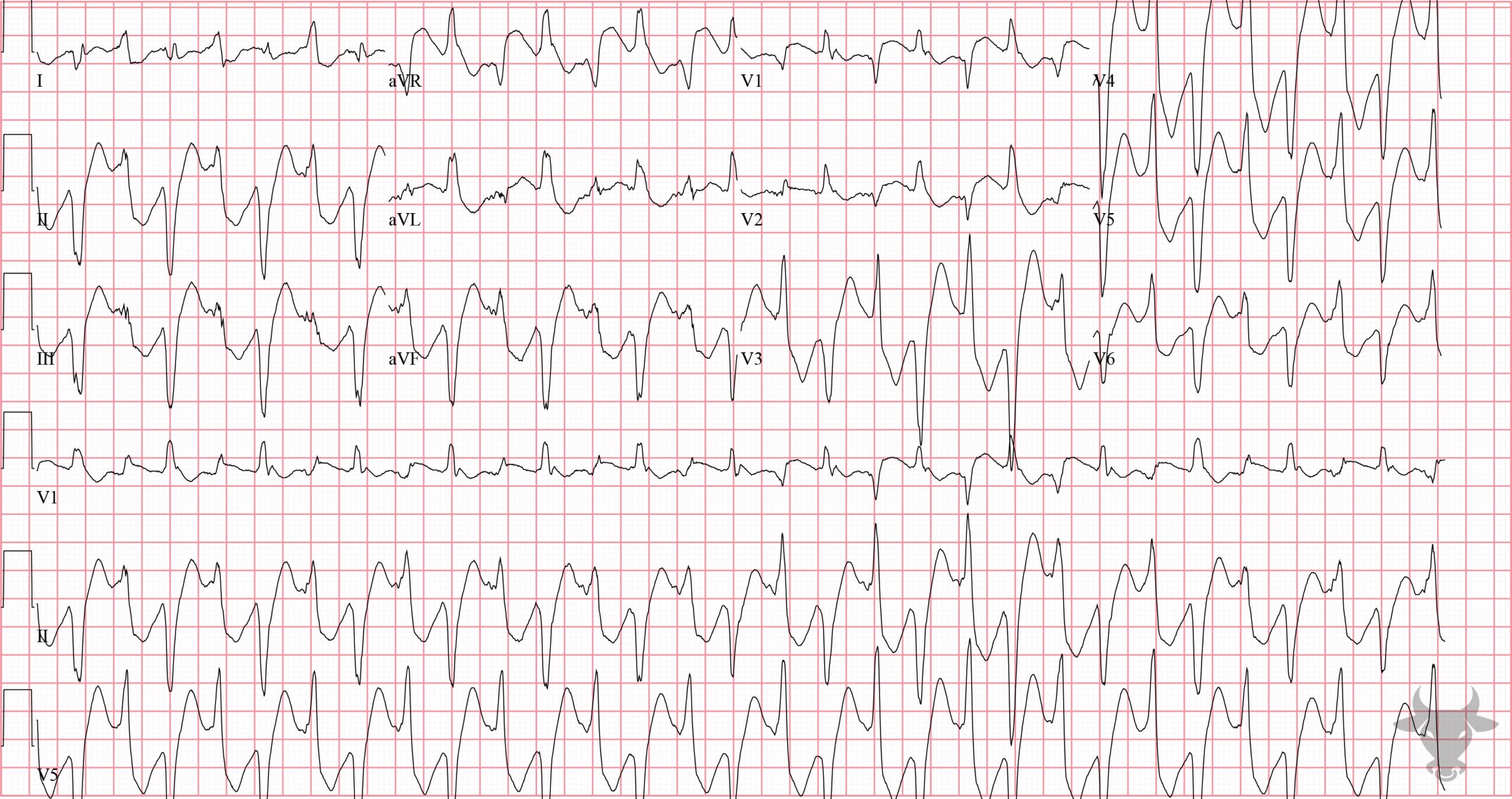 ECG Showing Polymorphic Ventricular Tachycardia