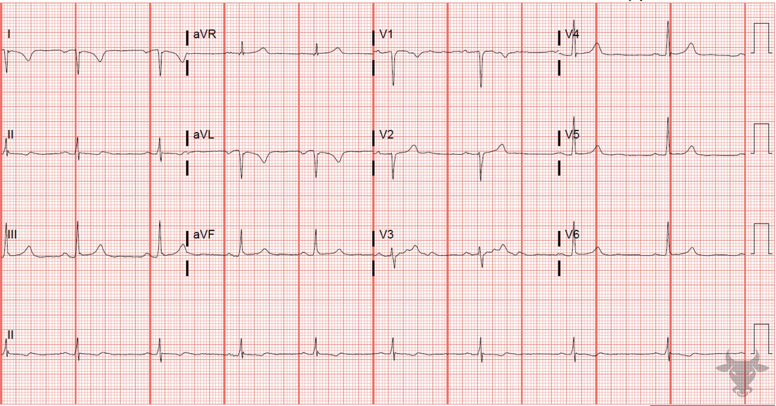 ECG Showing 43-LLR