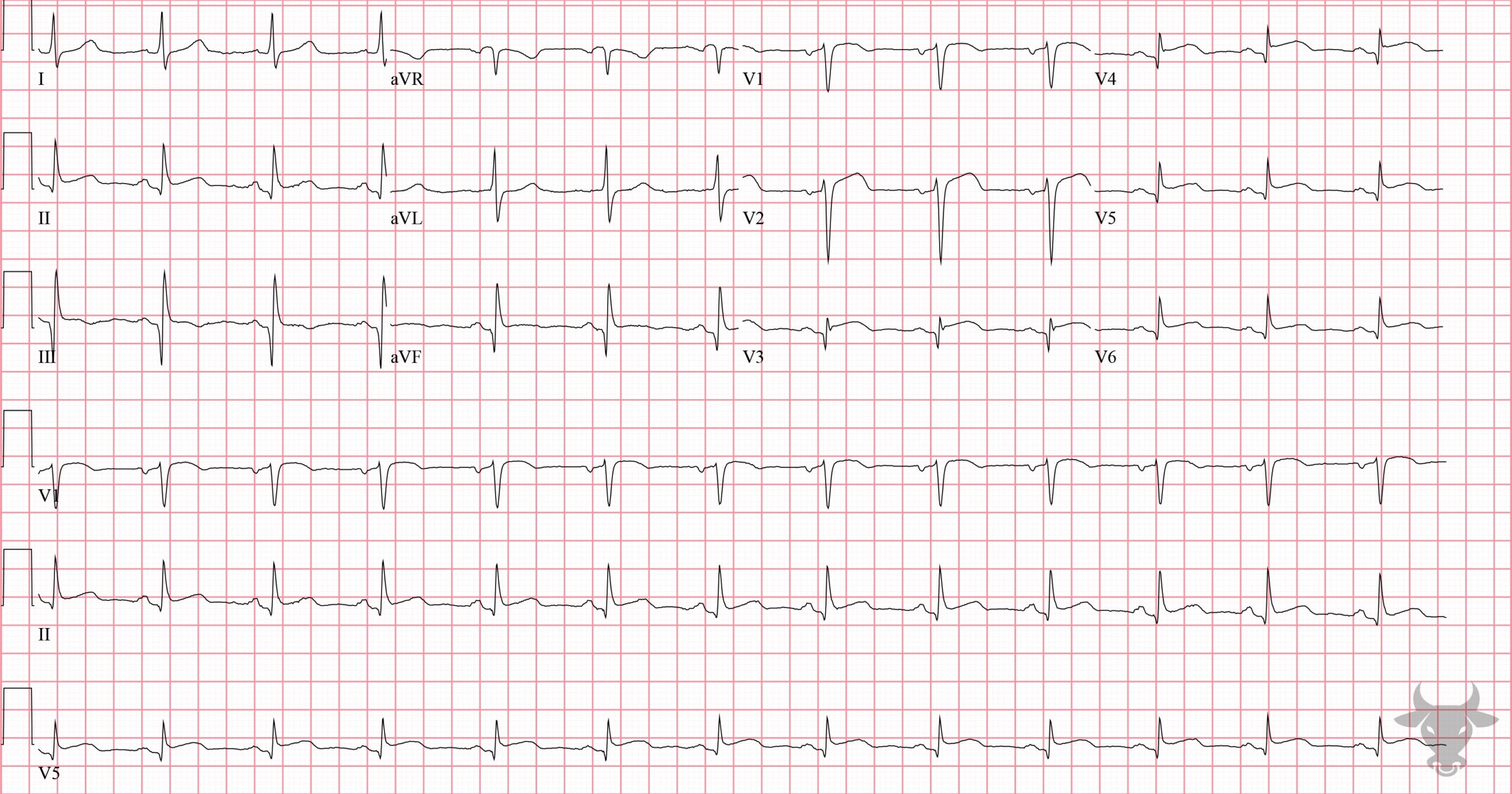 ECG Showing ST-elevation Myocardial Infarction