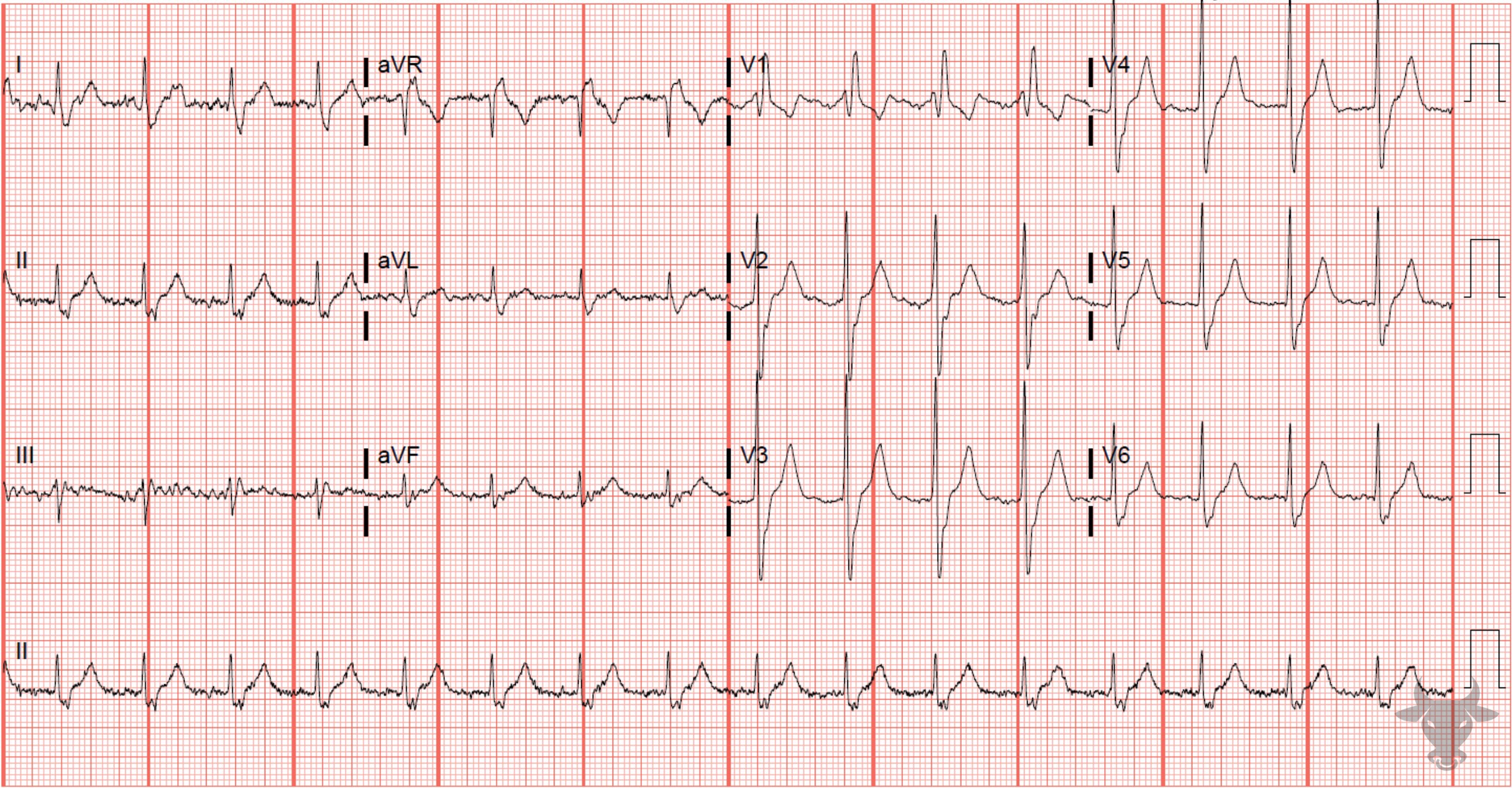 ECG Showing Right Bundle Branch Block