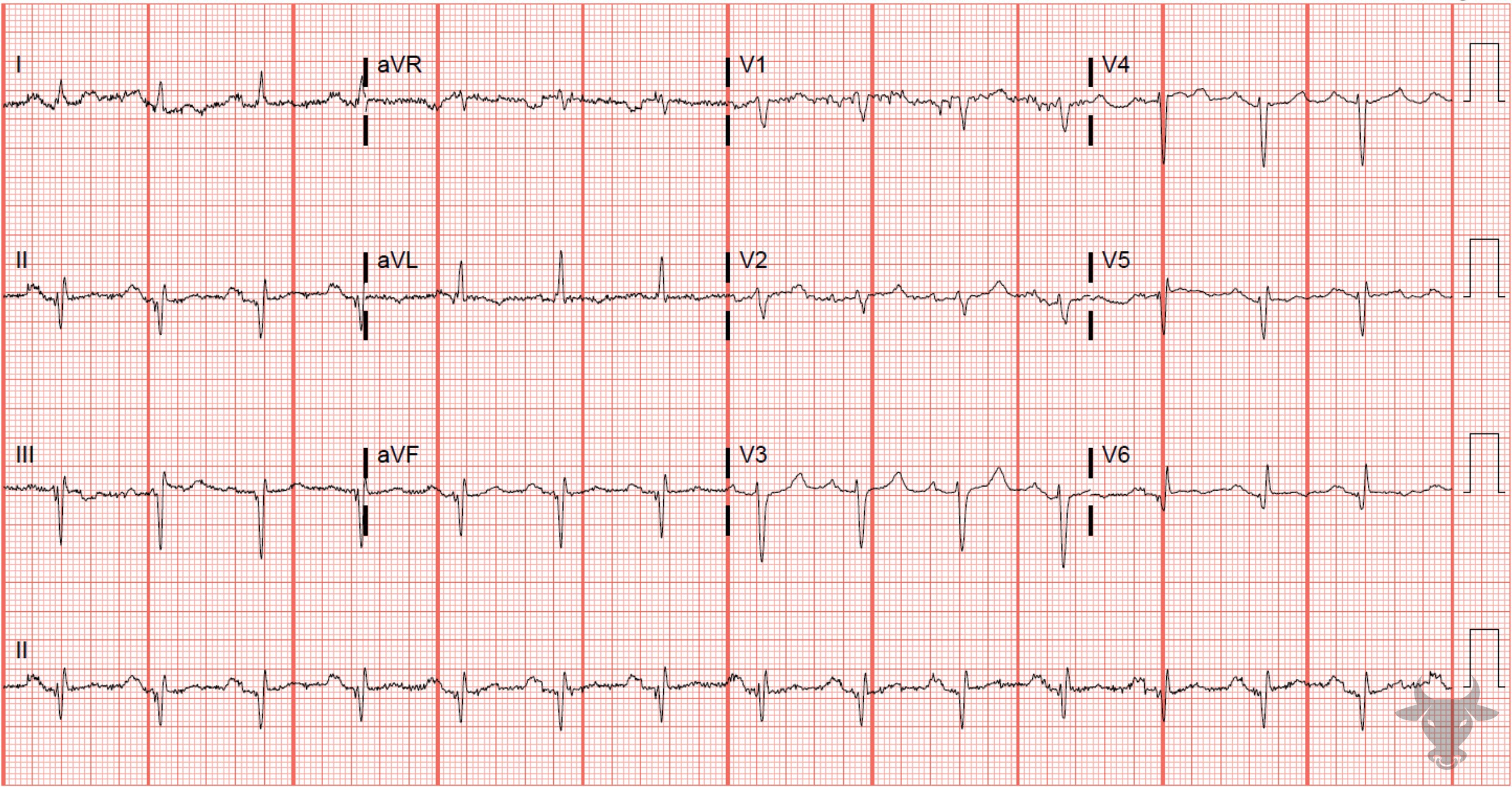 ECG Showing ST-elevation Myocardial Infarction