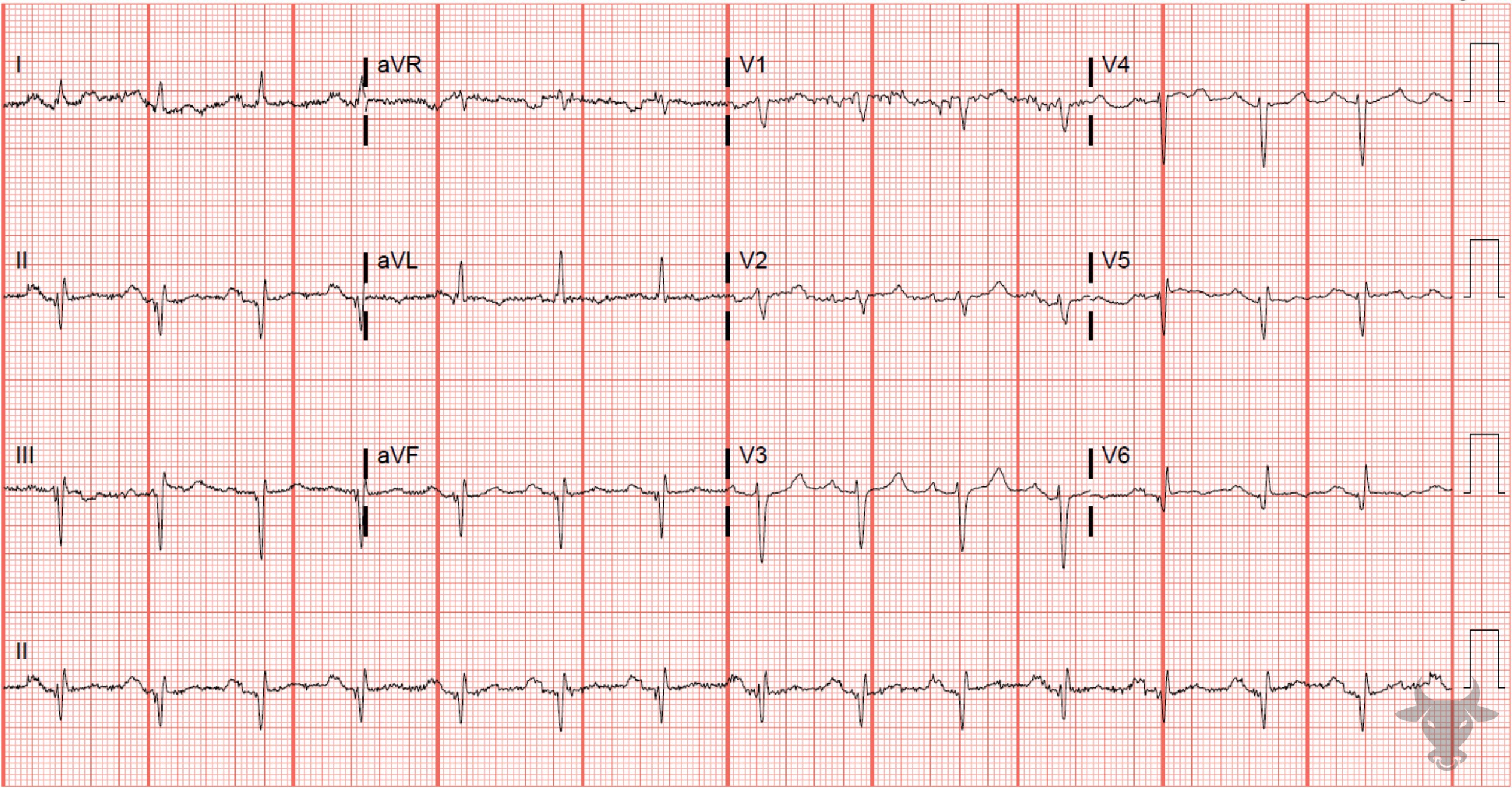 ECG Showing ST-elevation Myocardial Infarction