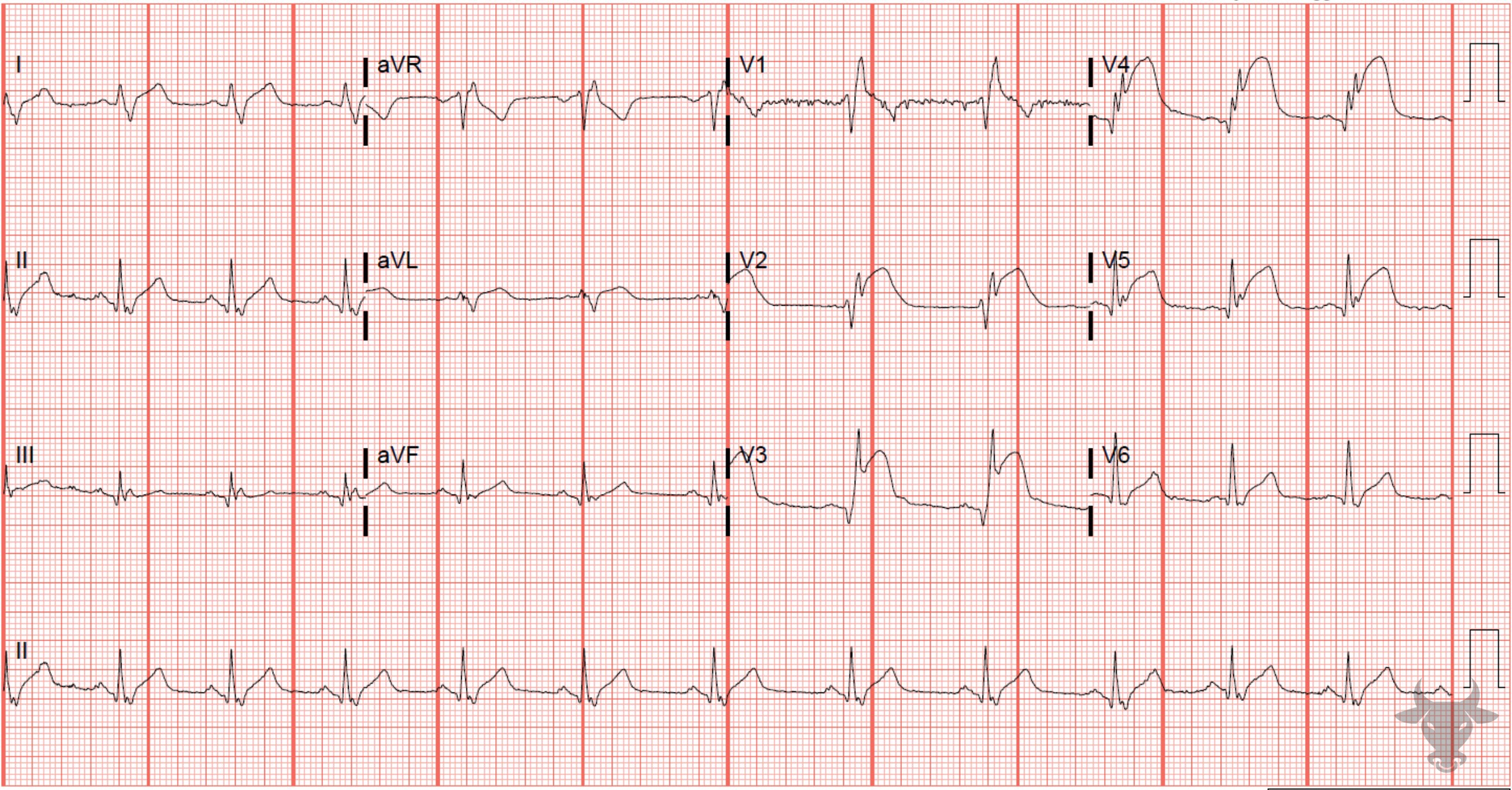 ECG Showing ST-elevation Myocardial Infarction