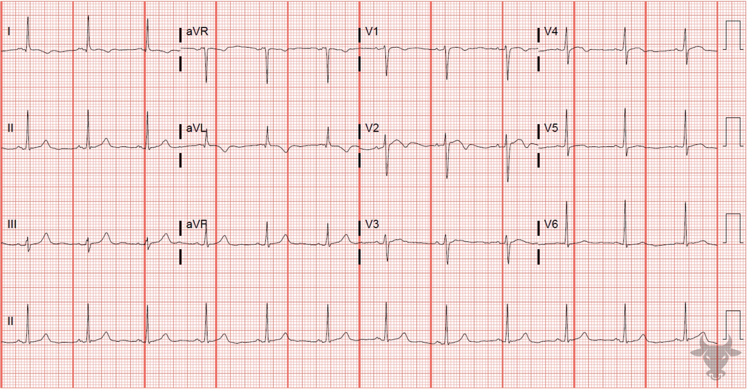 ECG Showing T-wave Inversions