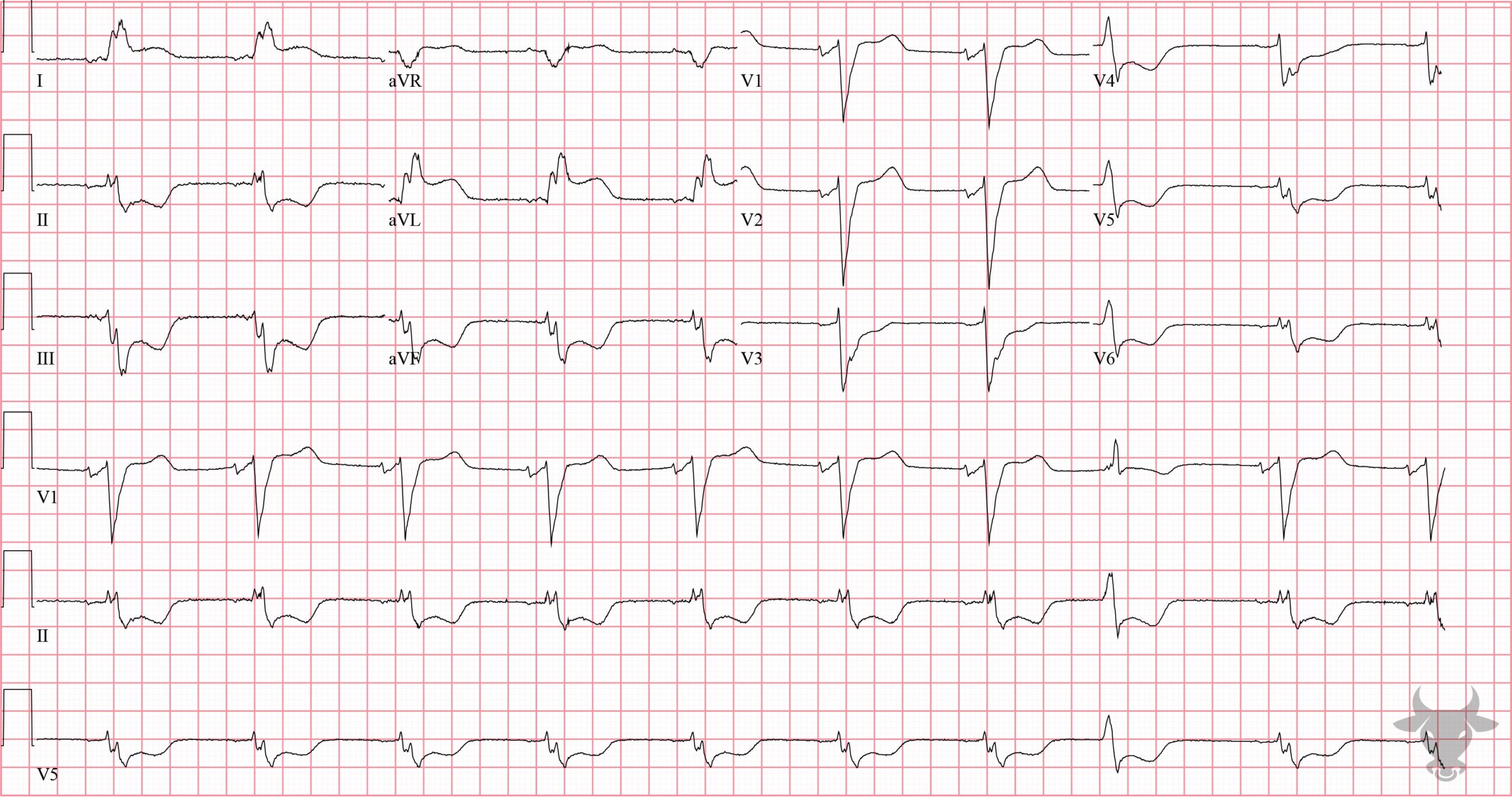 ECG Showing Sgarbossa Criteria