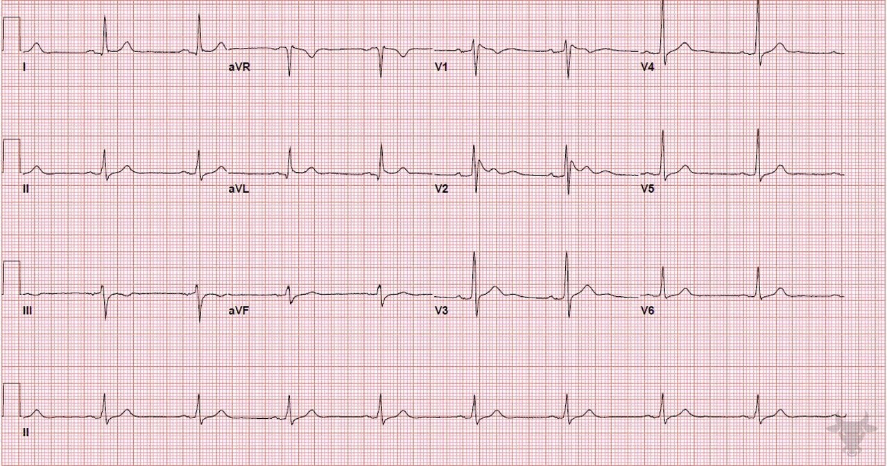 ECG Showing Brugada Syndrome