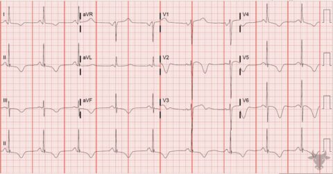 Cerebral T waves | ECG Stampede