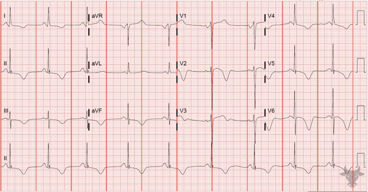 ECG Showing Cerebral T waves