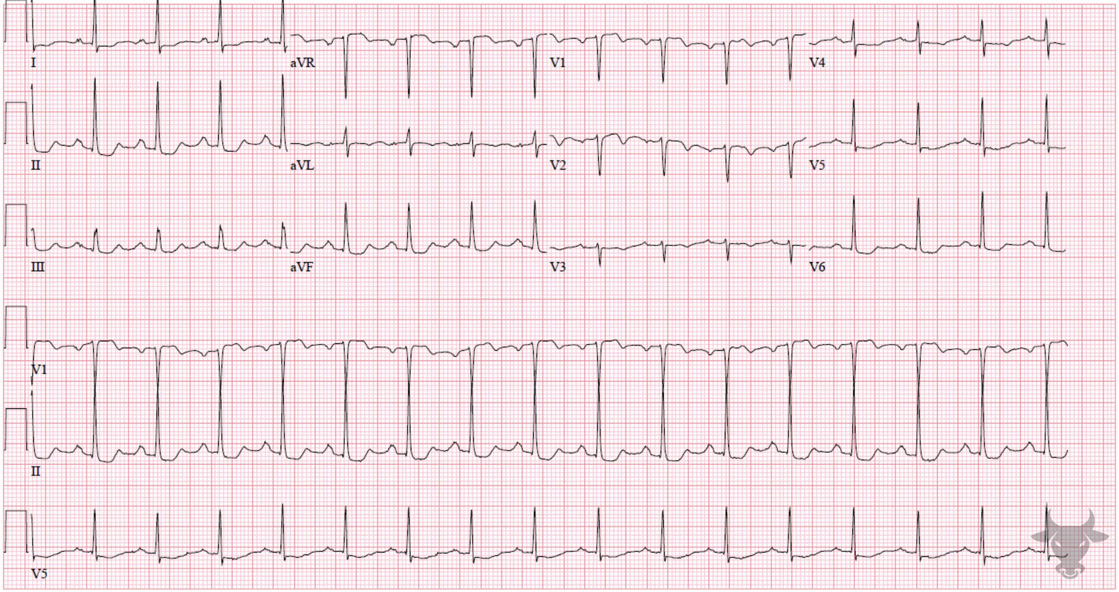 ECG Showing Global Subendocardial Ischemia