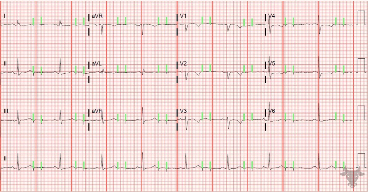 Pacemaker Malfunction Ecg Stampede Pacemaker Malfunction Ecg Stampede